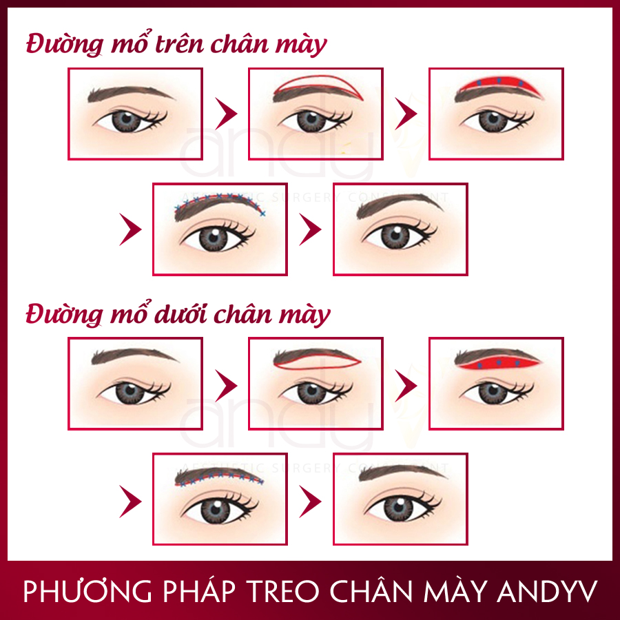 Tìm Hiểu Về Phương Pháp Nâng Cung Chân Mày ⋆ Kênh Tư Vấn Andyv 