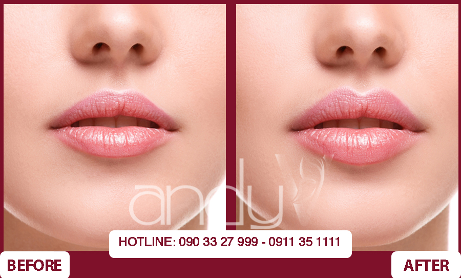Môi trái tim theo công nghệ AndyV