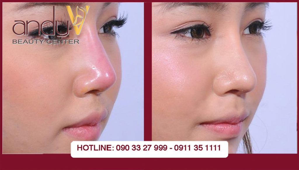 SỬA MŨI HỎNG BẰNG PHƯƠNG PHÁP NÂNG MŨI CẤU TRÚC ANDYV