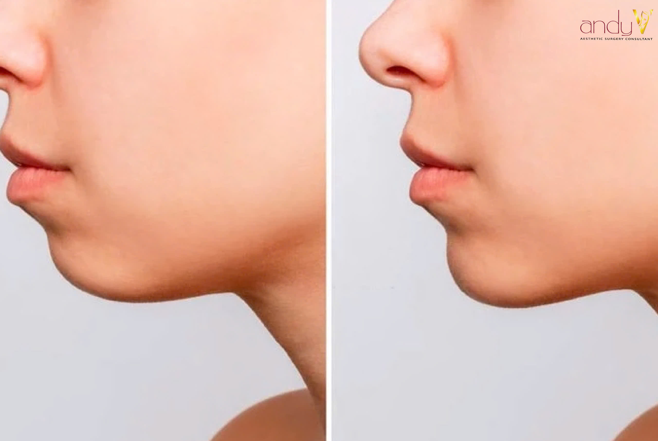 Hình ảnh trước và sau khi cấy mỡ cằm bằng mỡ tự thân