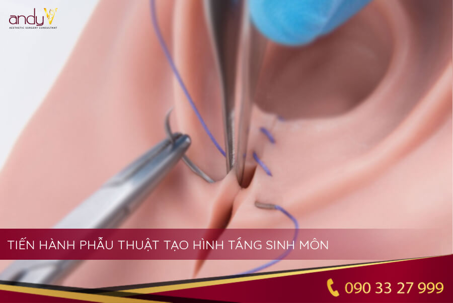 Tạo hình tầng sinh môn