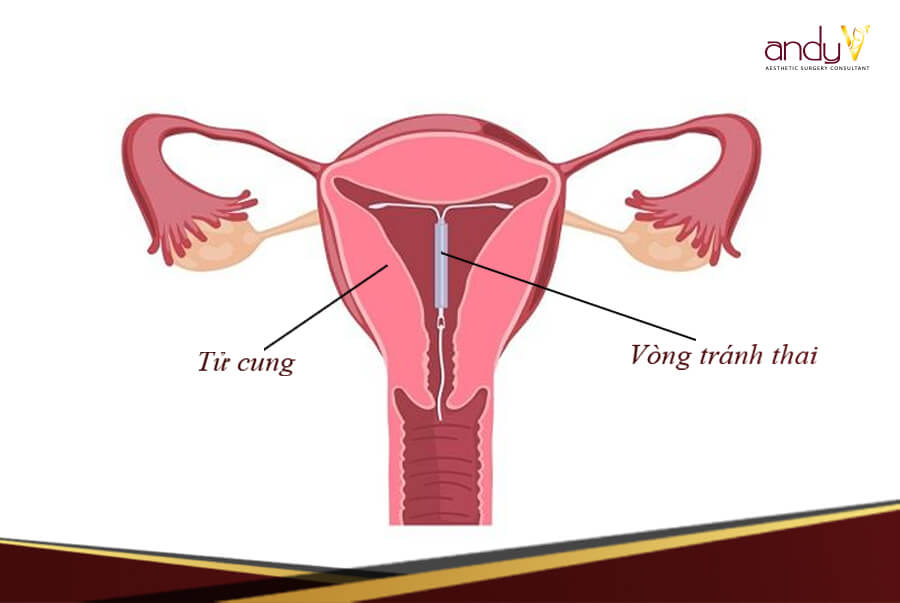 phòng tránh thai 3 phòng tránh thai 3