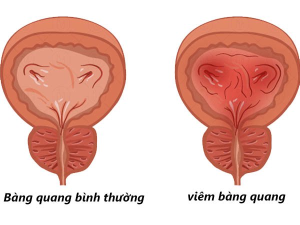 Viêm bàng quang 1