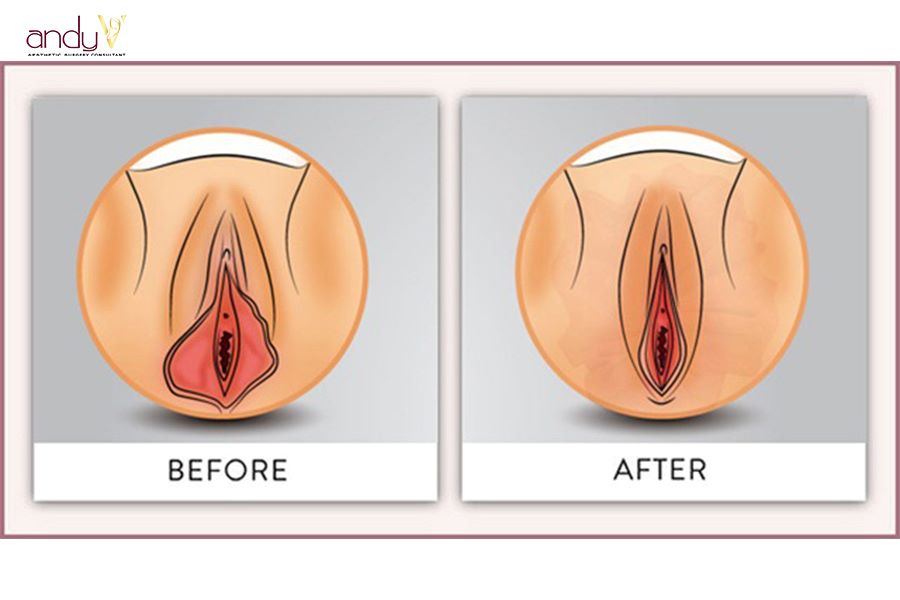 Lợi ích của việc cắt môi bé là gì?