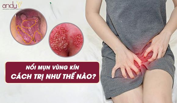 Nổi mụn cứng ở vùng kín nữ giới? Nguyên nhân do đâu ⋆