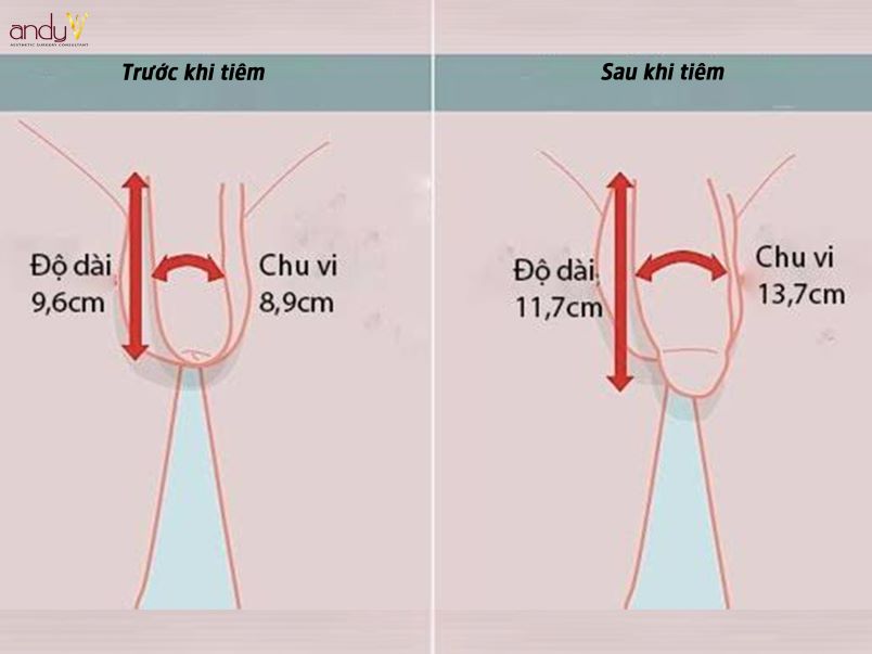 Ưu điểm của phương pháp làm to cậu nhỏ bằng Megafill không phẫu thuật