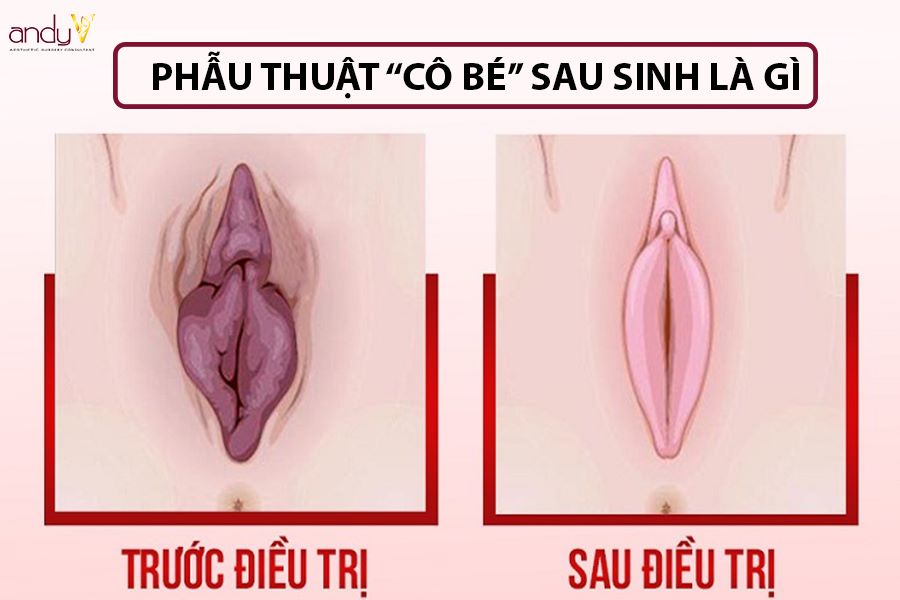 Một số phương pháp Phẫu thuật cô bé sau sinh thường được thực hiện