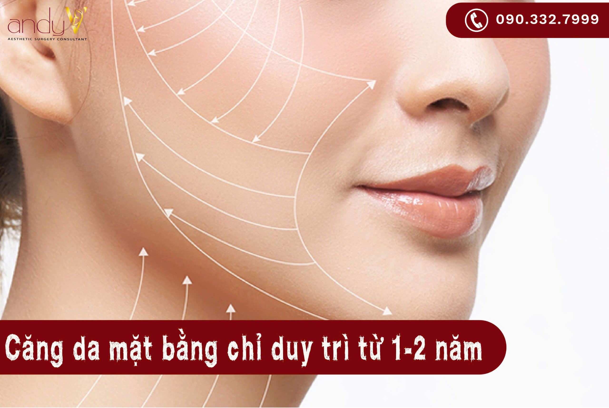 Căng da mặt bằng chỉ duy trì từ 1-2 năm