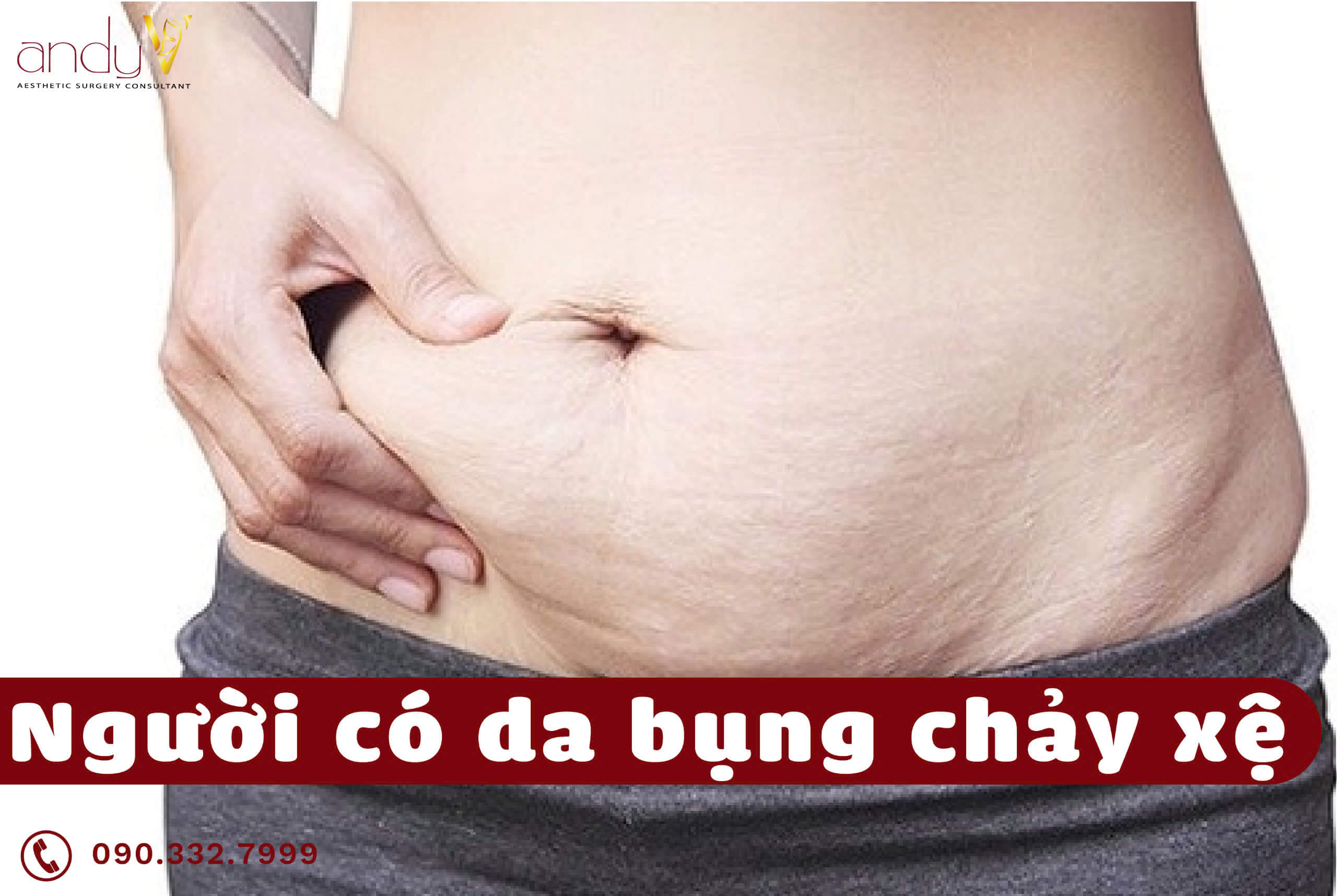 Người có da bụng chảy xệ