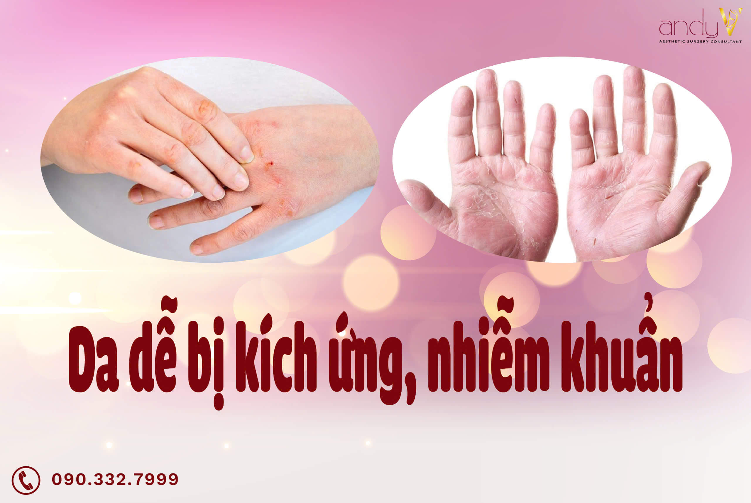 Da dễ bị kích ứng, nhiễm khuẩn