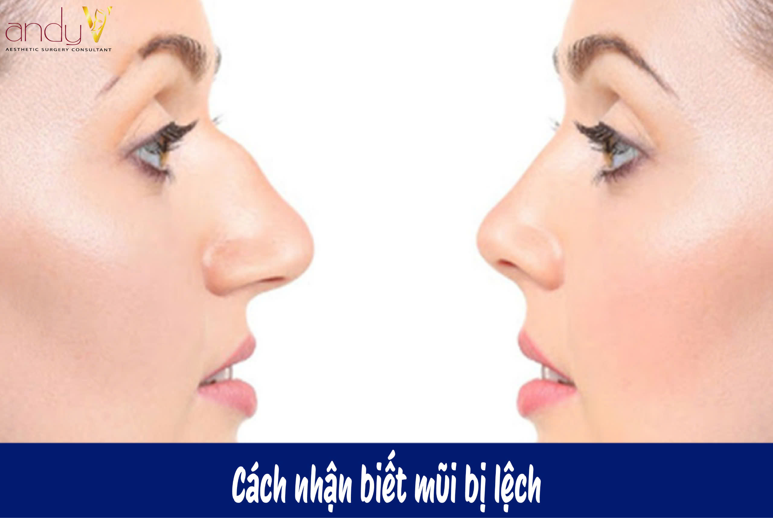 Nhận diện mũi lệch trực quan qua ảnh chụp các góc độ