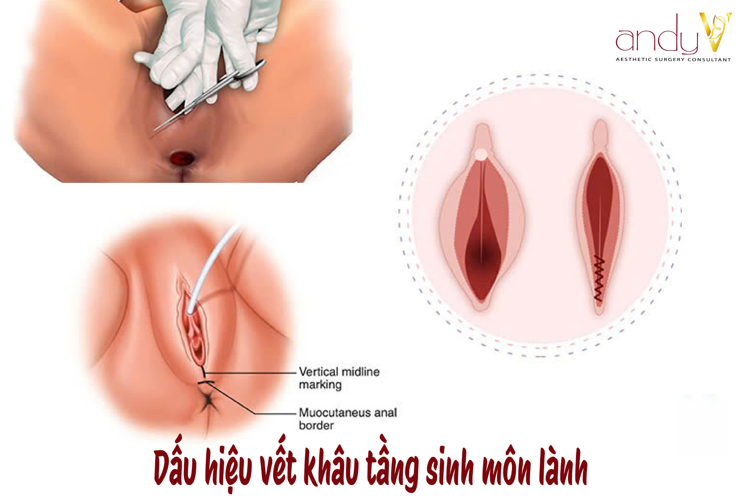 Nhận diện dấu hiệu tích cực của quá trình hồi phục tầng sinh môn