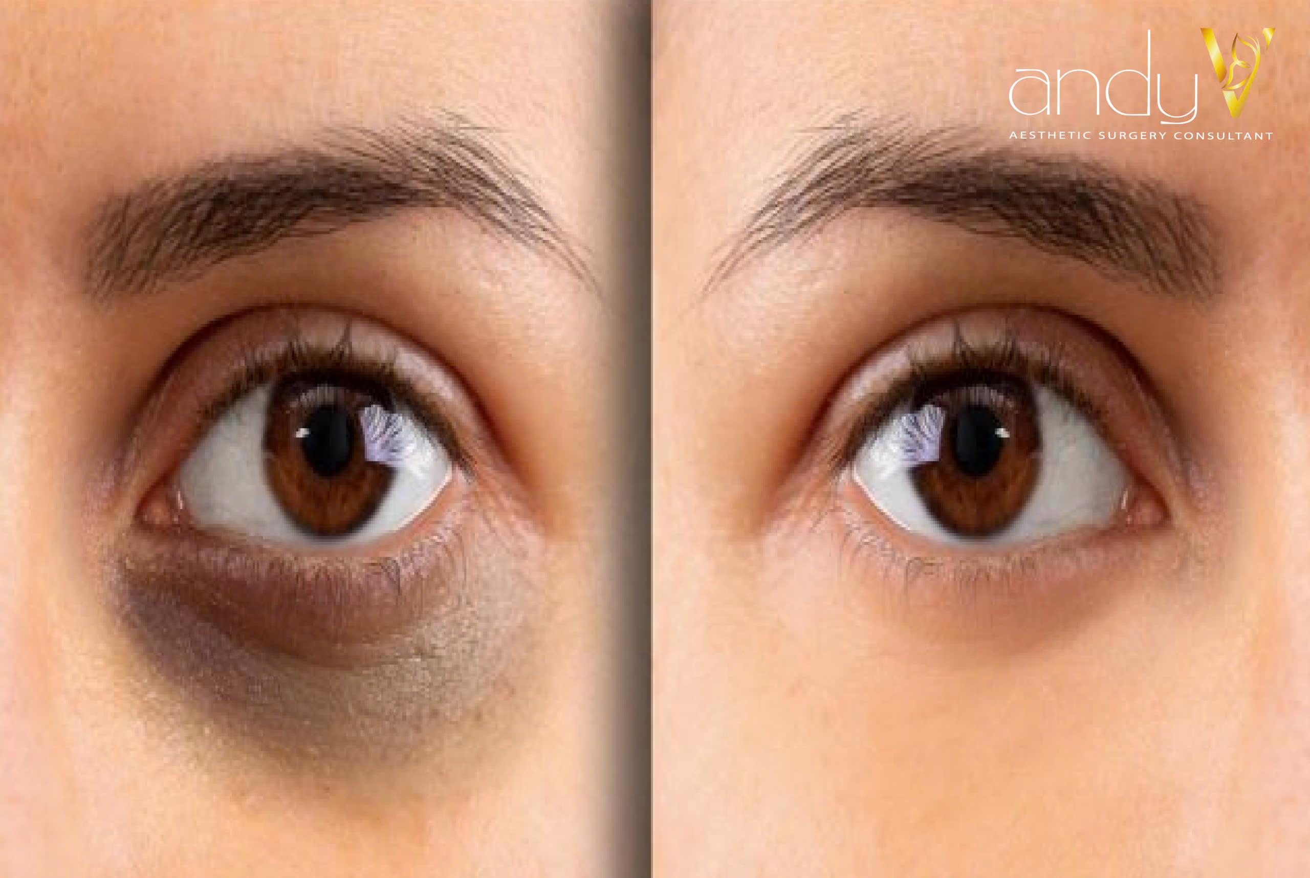 Hình ảnh trước và sau khi xóa thâm quầng mắt