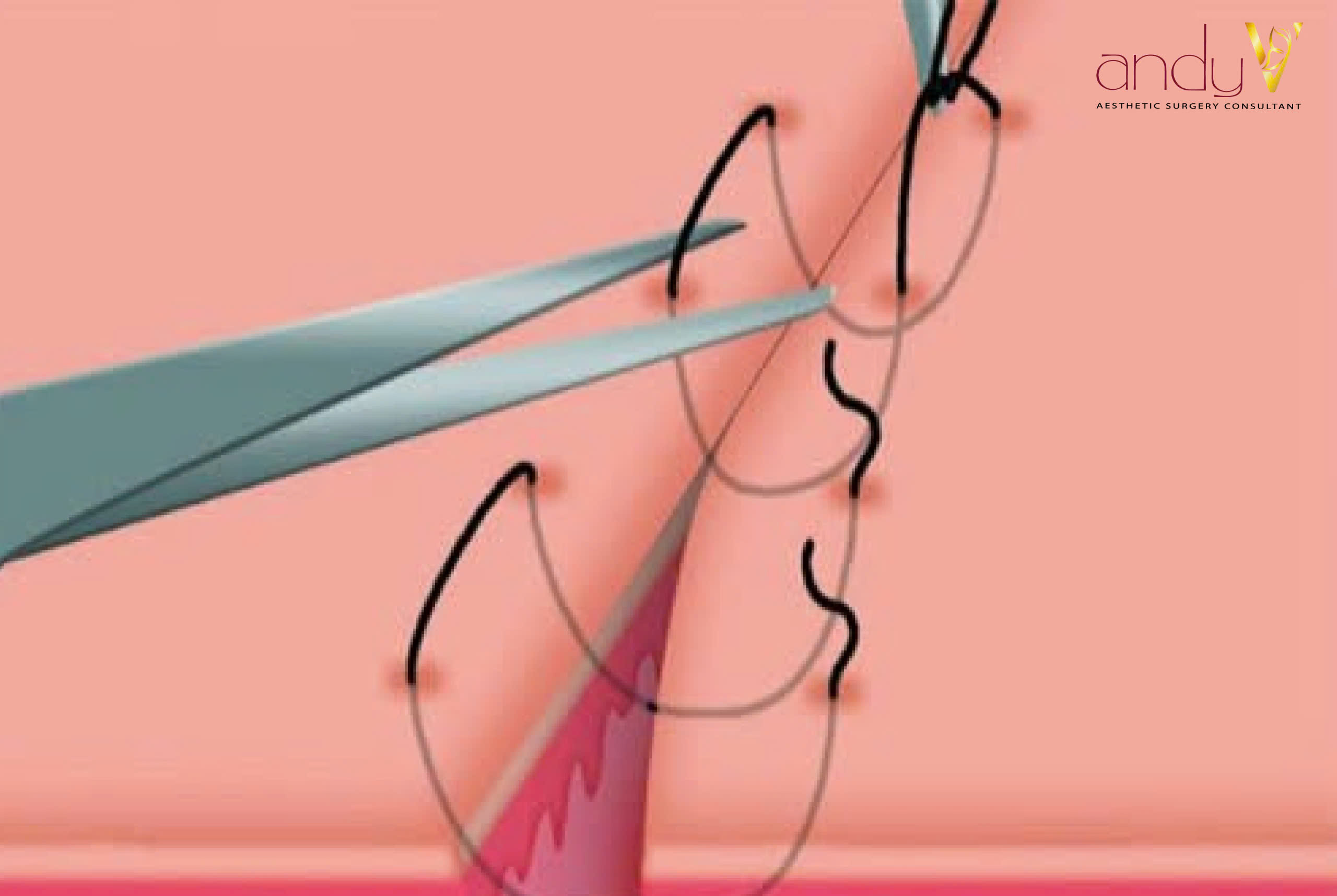 Khâu tầng sinh môn bằng chỉ tự tiêu không cần cắt chỉ sau sinh