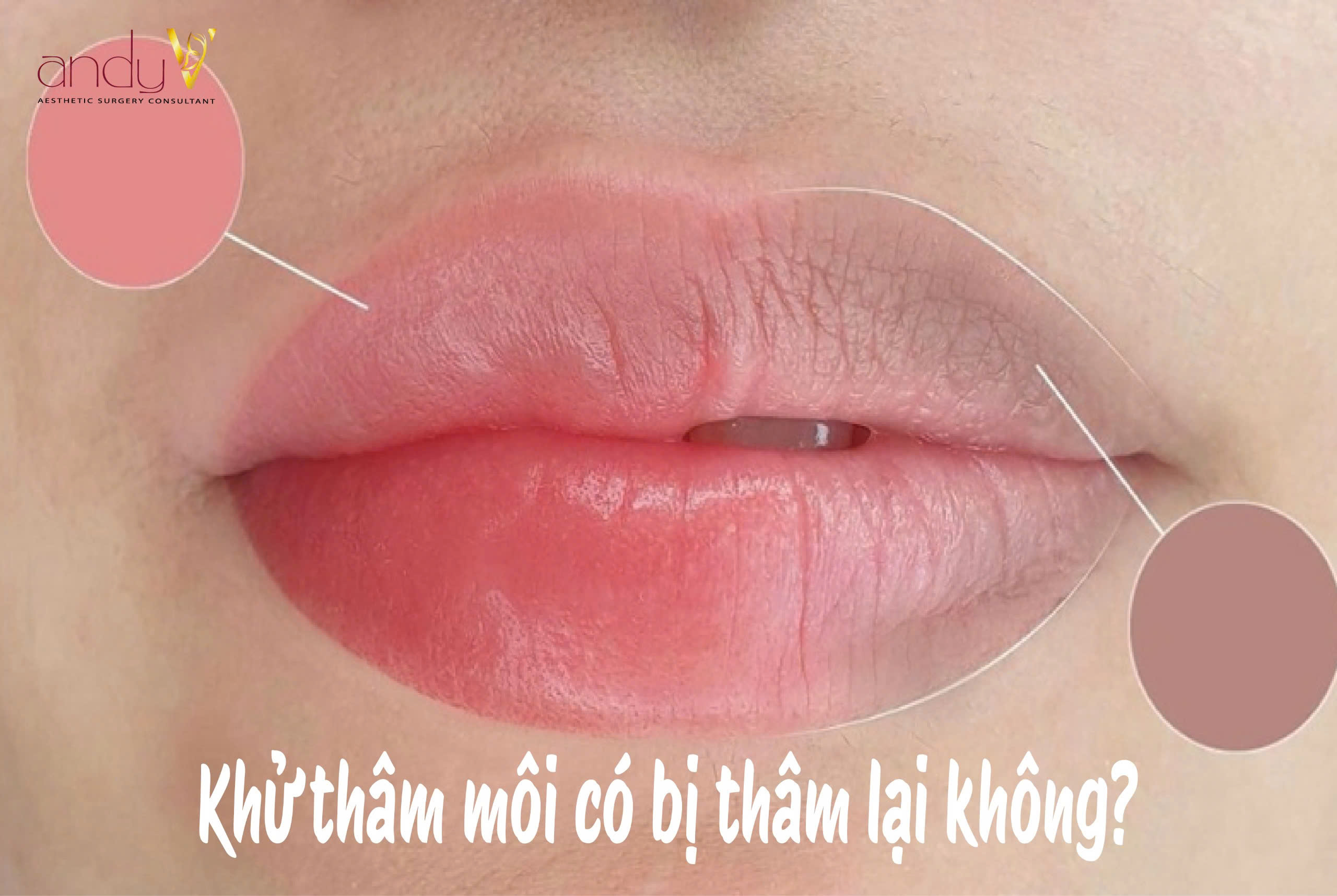 Bí quyết giữ môi hồng hào sau khử thâm, tránh thâm lại