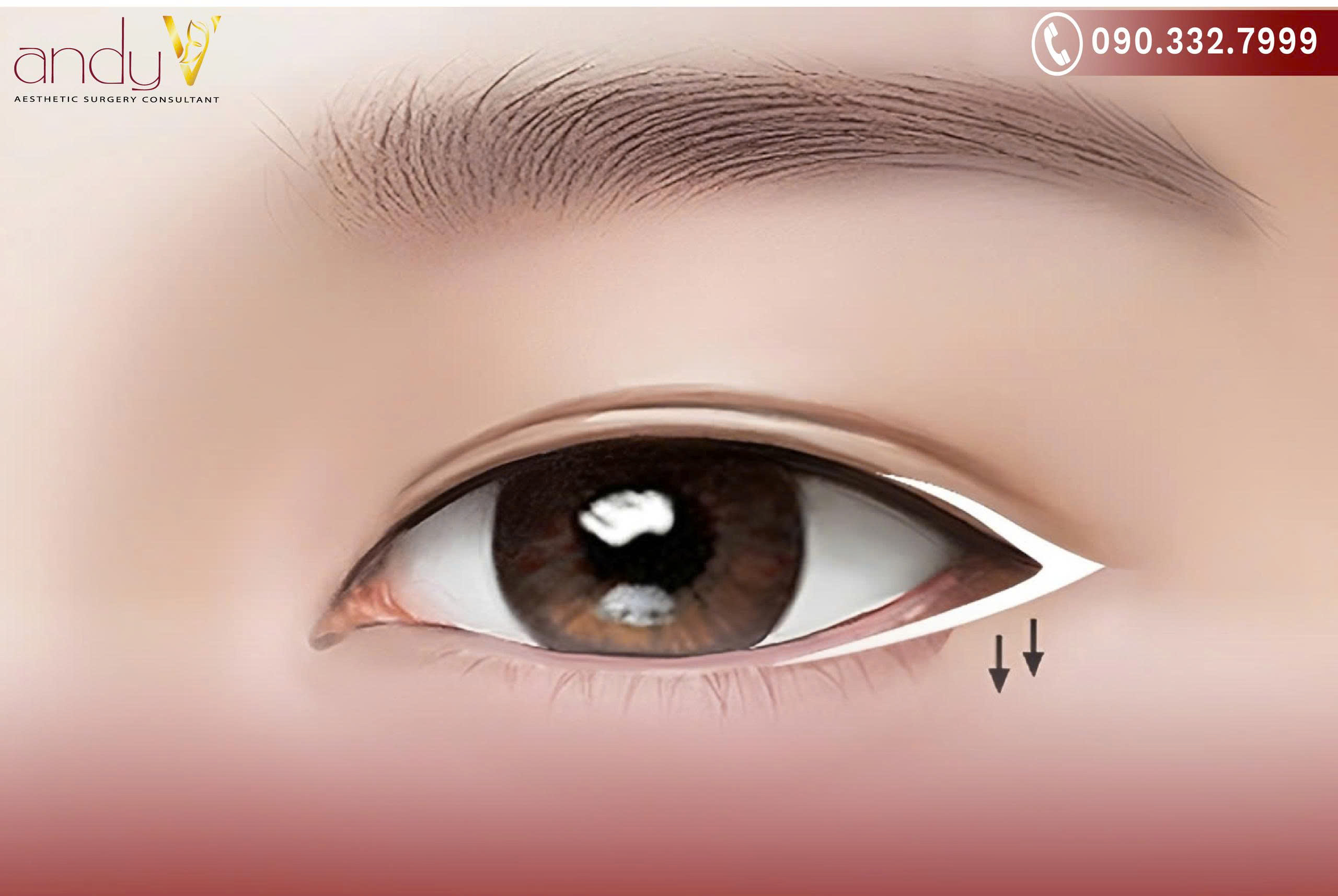 Giải pháp mở rộng góc mắt ngoài giúp mắt cân đối và hài hòa tổng thể