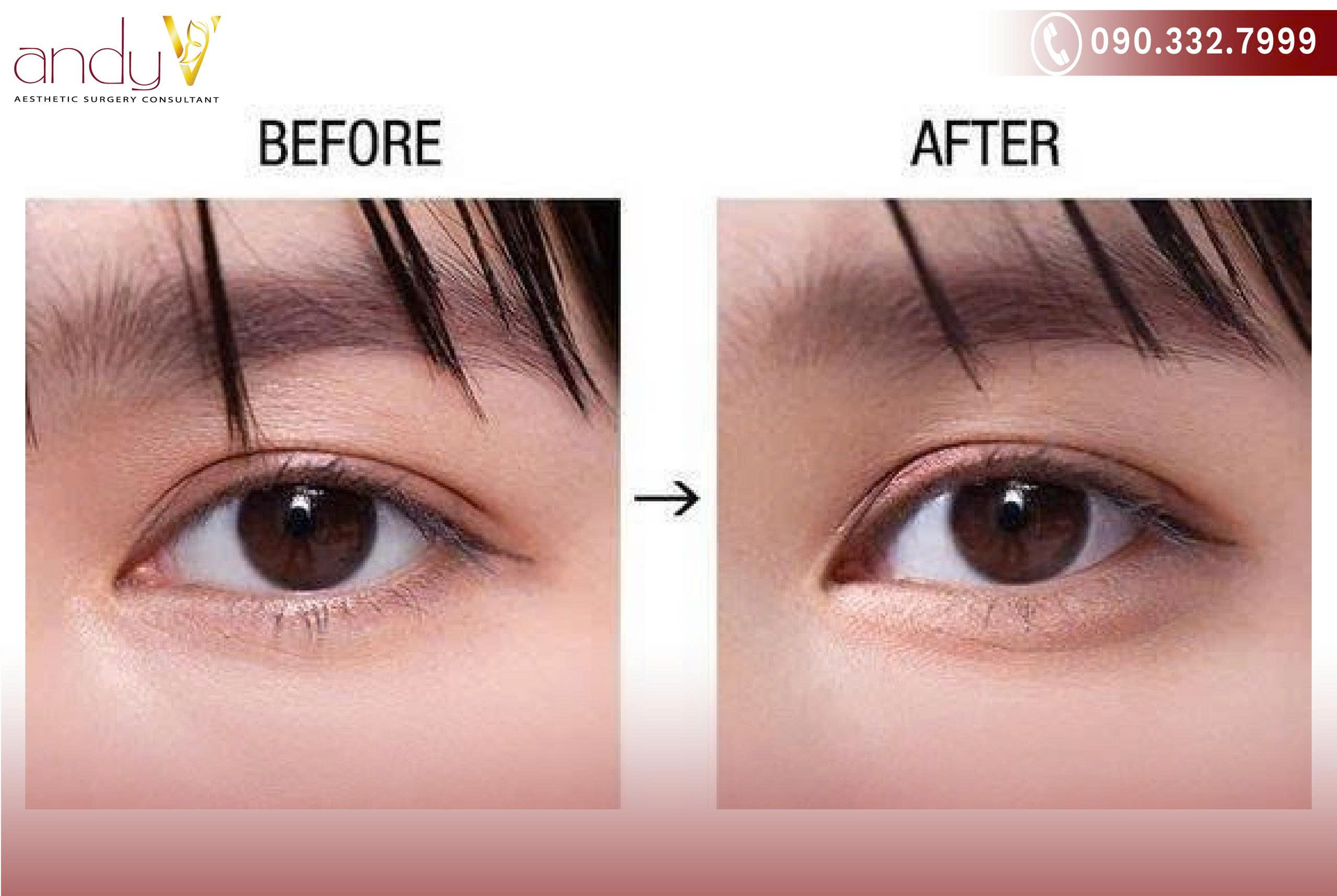 Hình ảnh trước và sau khi phẫu thuật mở góc mắt trong