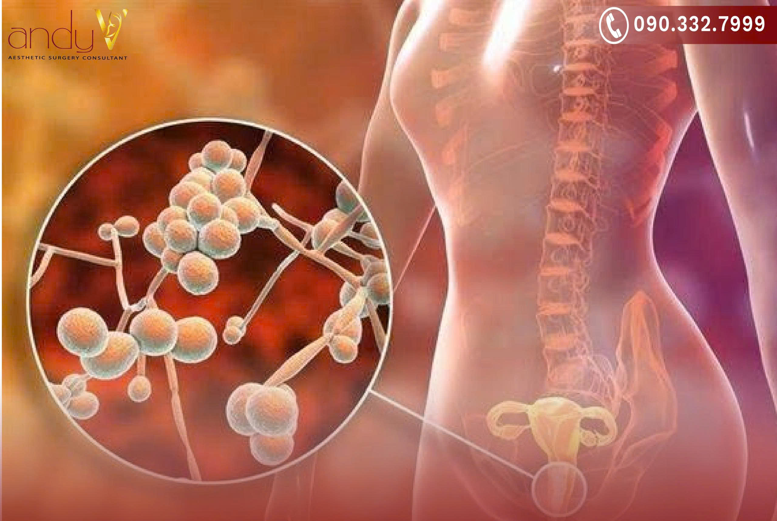 Viêm nhiễm âm đạo nguyên nhân chủ yếu gây ra bệnh huyết trắng