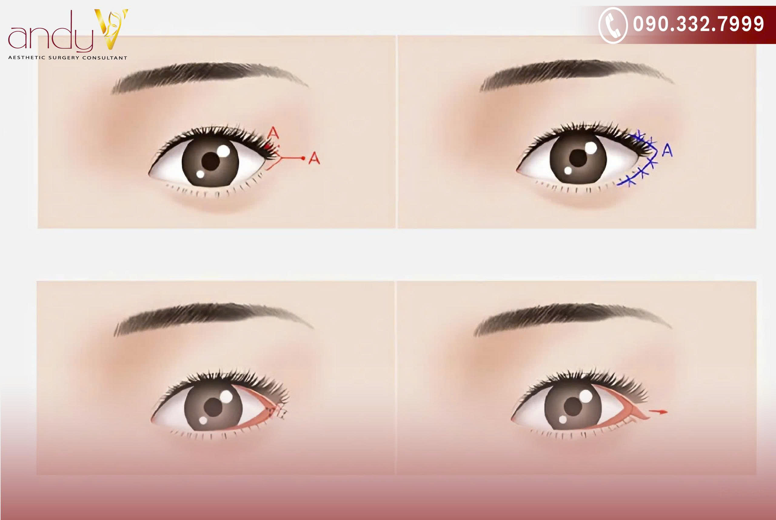 Hình ảnh minh họa quy trình mở rộng góc mắt ngoài từng bước