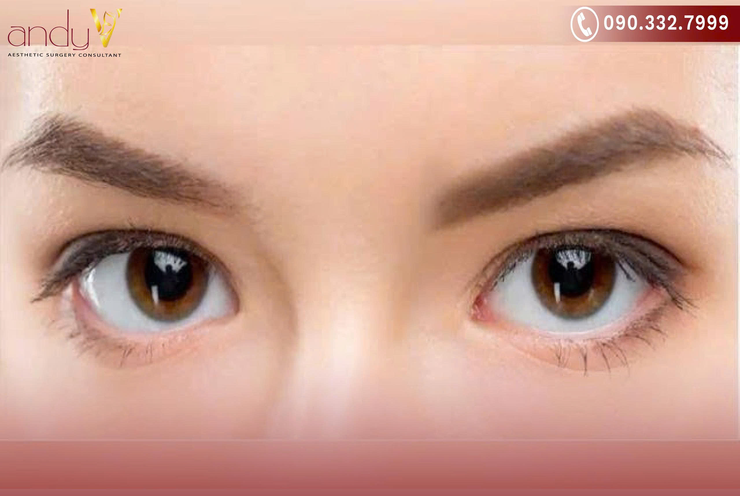 Nhận diện những trường hợp lý tưởng mở rộng góc mắt trong để tối ưu hóa vẻ đẹp đôi mắt