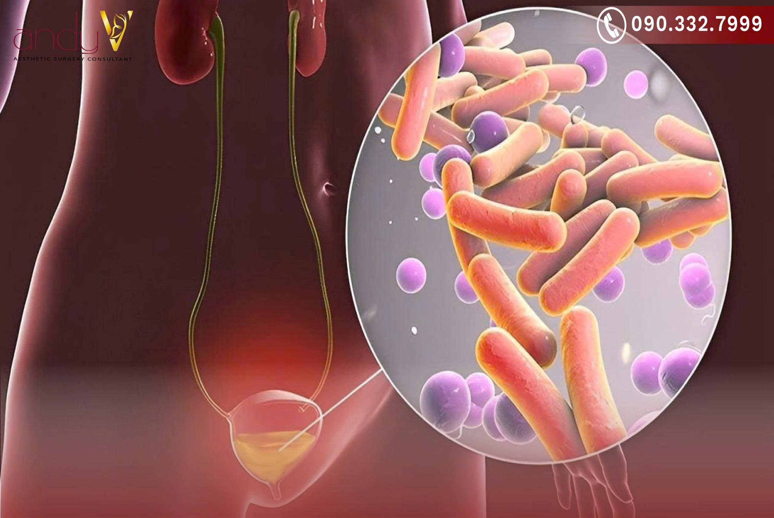 Nguyên nhân viêm thường do vi khuẩn (E. coli), vệ sinh kém, hoặc do các yếu tố không nhiễm trùng