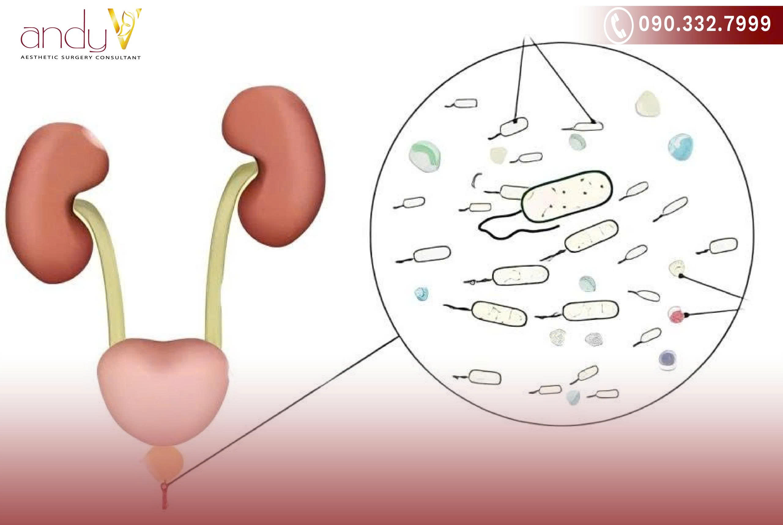 Nguyên nhân chính thường là do nhiễm khuẩn, nhưng cũng có thể do tổn thương