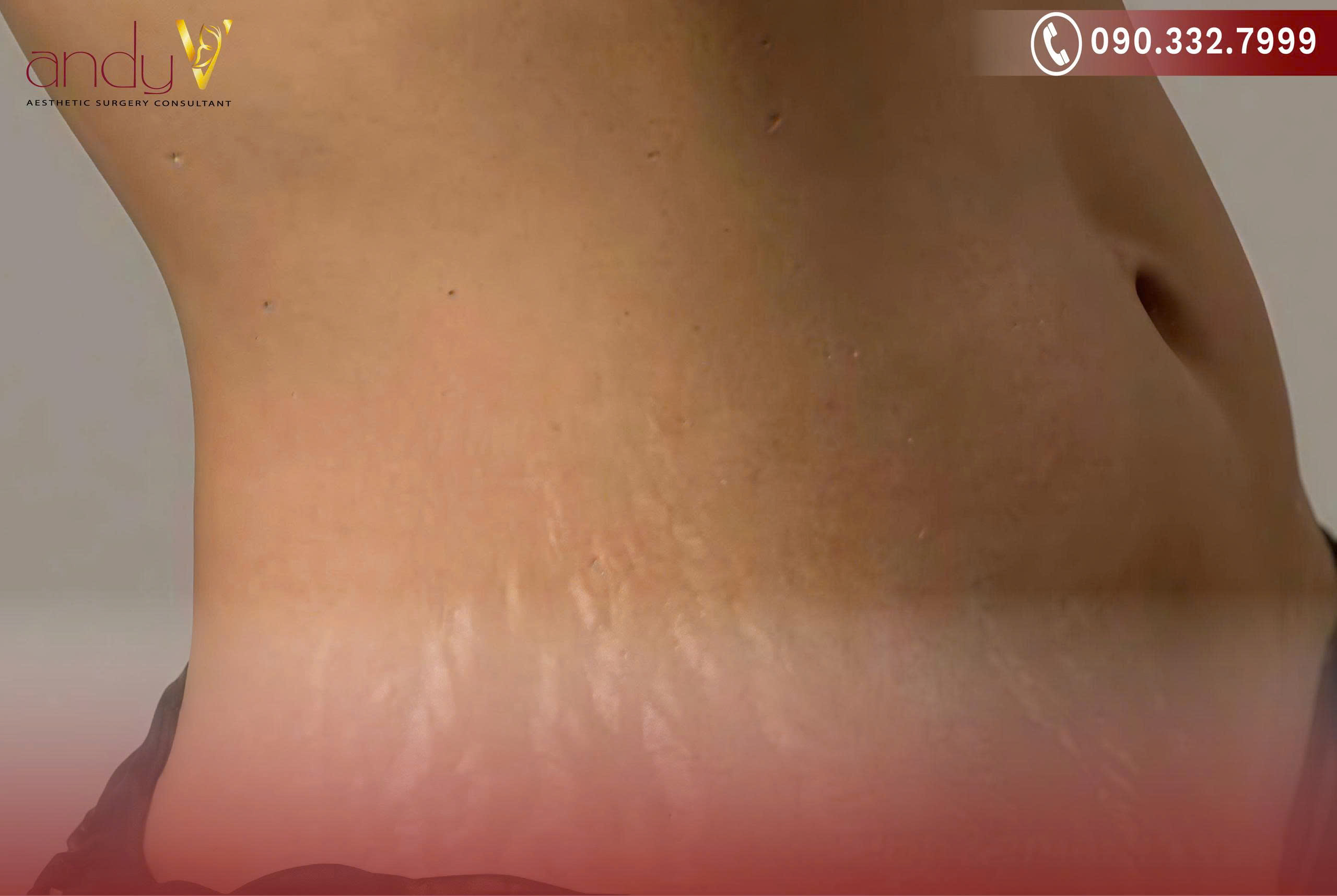 Xuất hiện các vệt sọc màu hồng, đỏ hoặc tím trên da