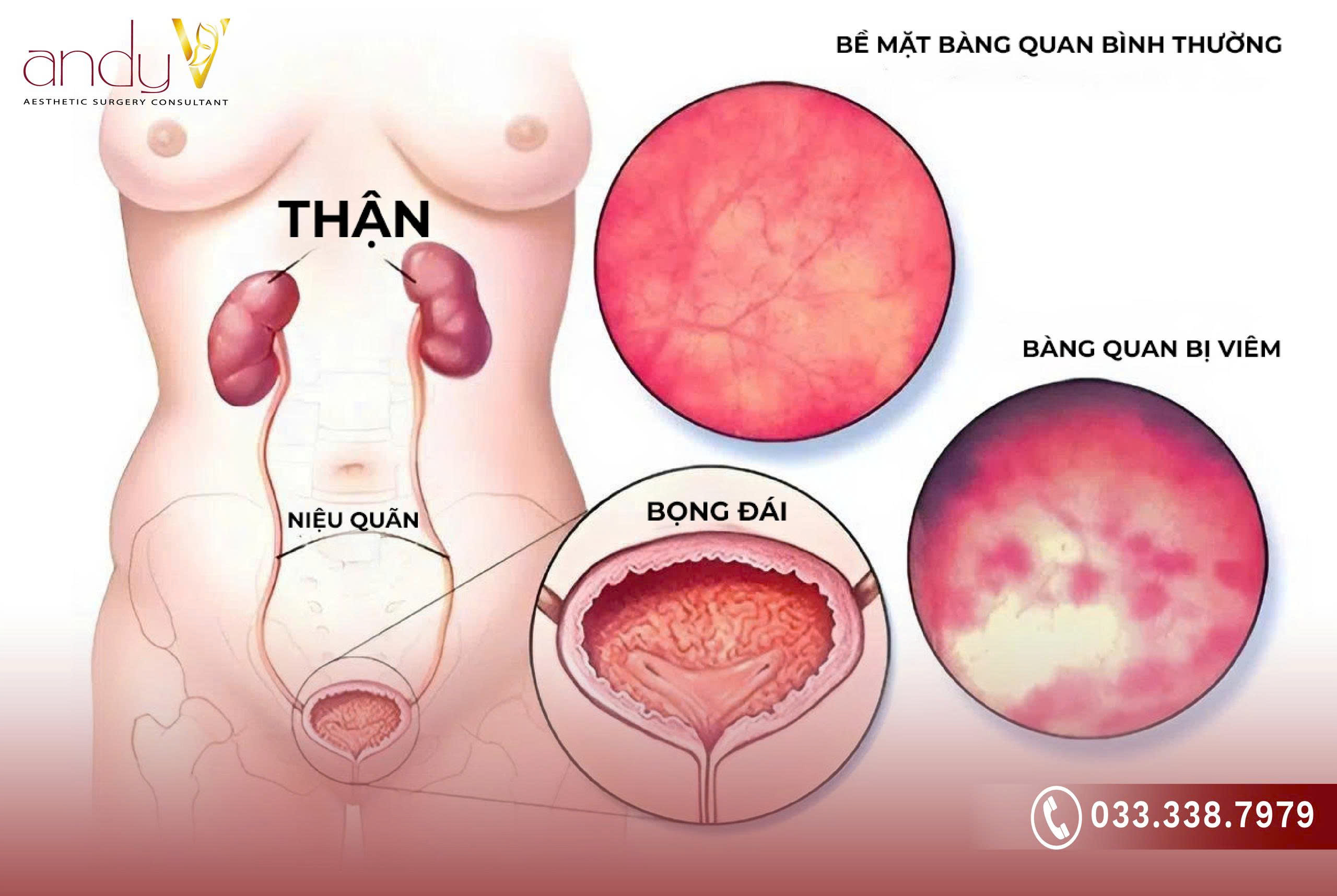 Viêm bàng quang không nguy hiểm tính mạng nếu được điều trị