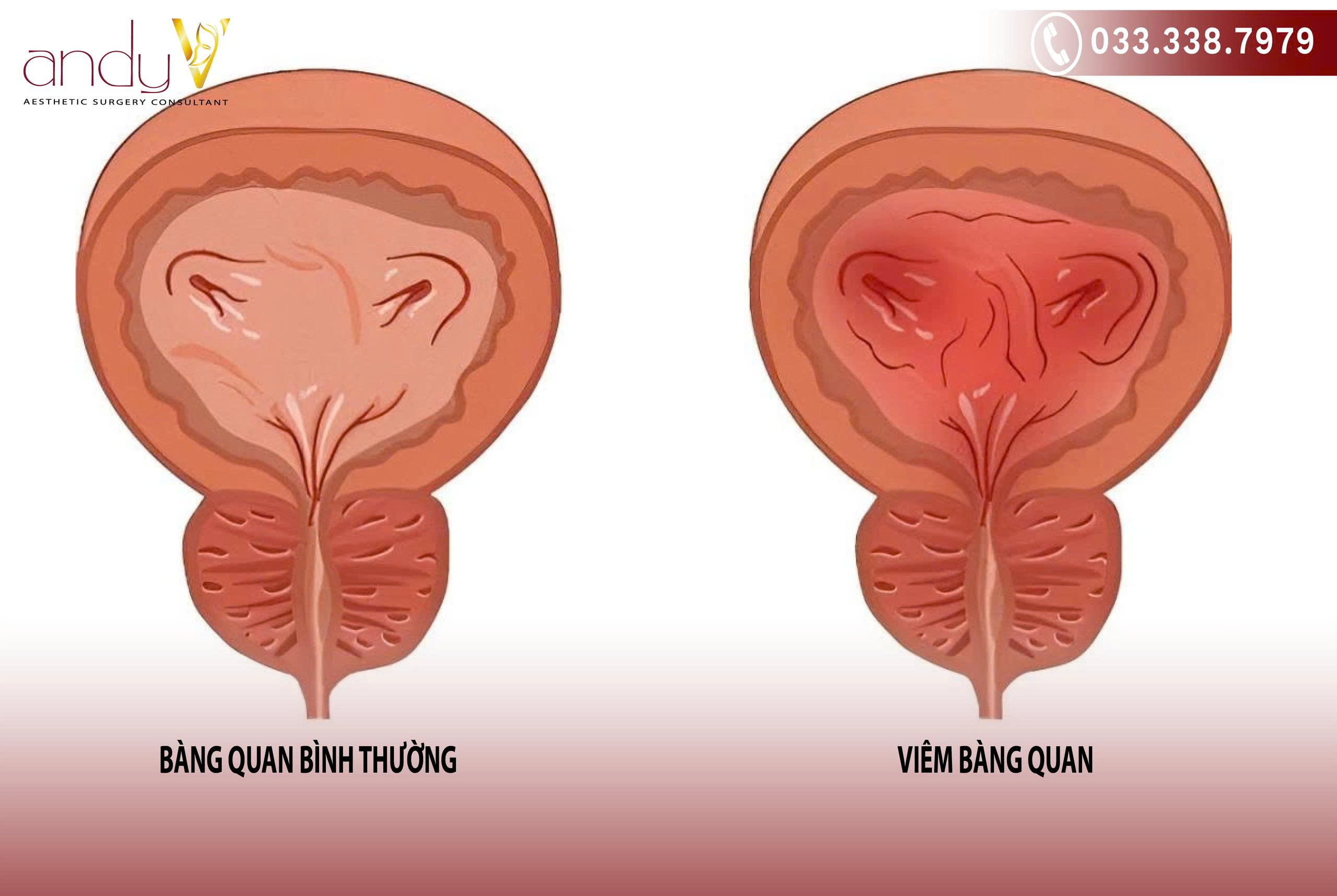 Các triệu chứng chính của viêm bàng quang bao gồm tiểu buốt, tiểu rắt, đau bụng dưới và nước tiểu đục