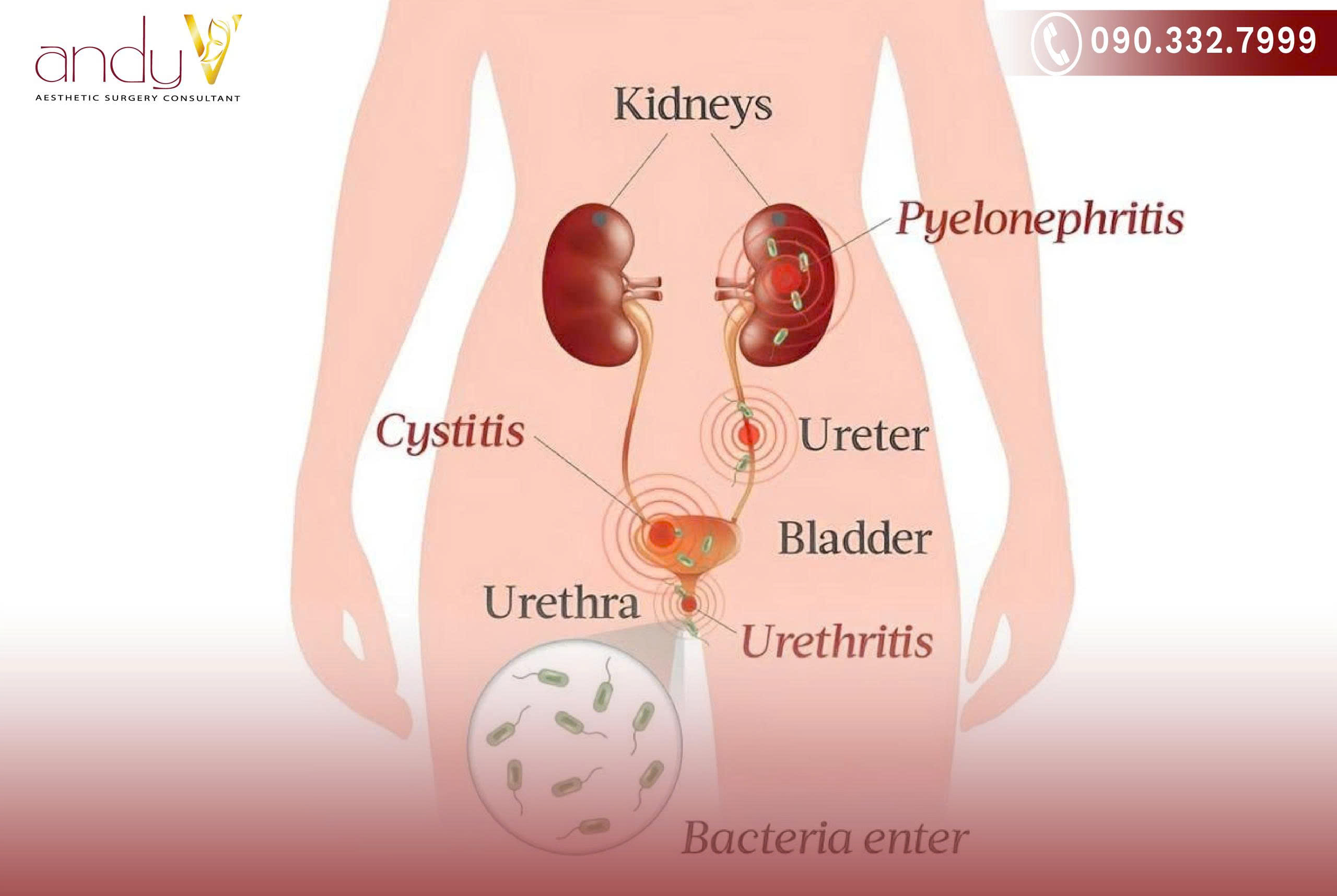 Viêm nhiễm ở niệu đạo hoàn toàn có thể phòng ngừa được bằng cách áp dụng các biện pháp vệ sinh và lối sống lành mạnh