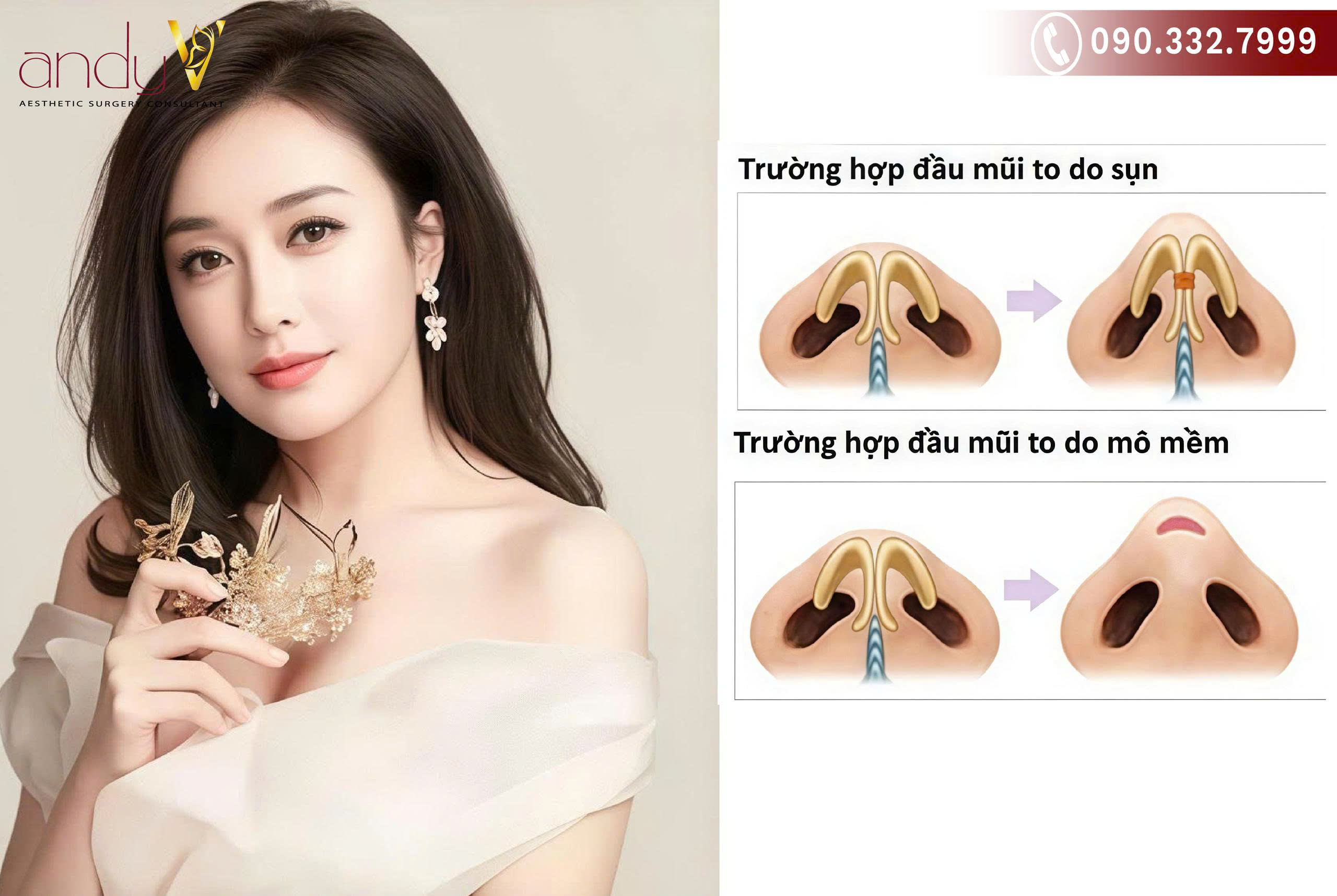 Cải thiện dáng mũi sư tử bằng cách trang điểm hoặc phẫu thuật thẩm mỹ