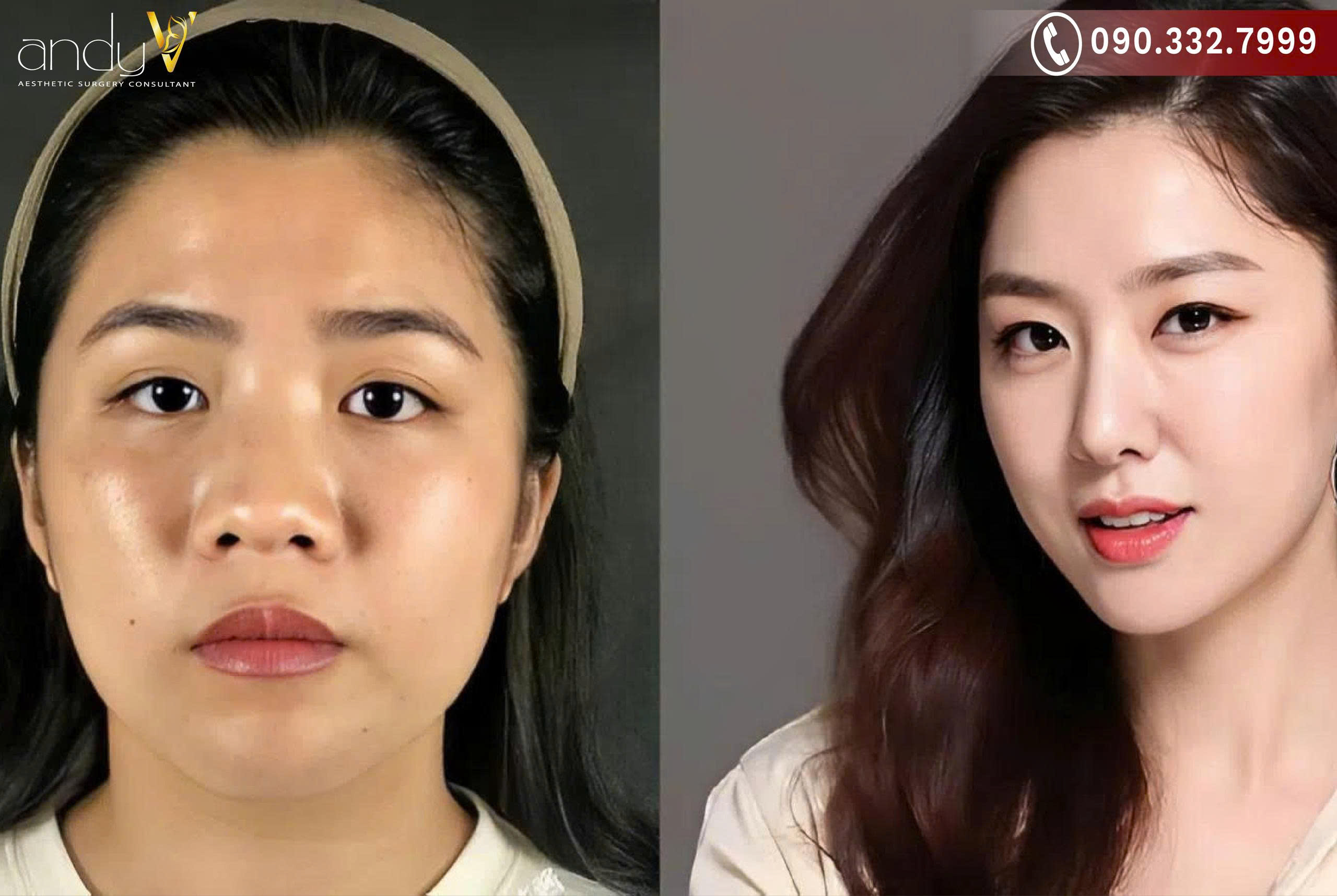 Để khắc phục dáng mũi tẹt, có nhiều phương pháp khác nhau, từ không phẫu thuật cho đến phẫu thuật thẩm mỹ