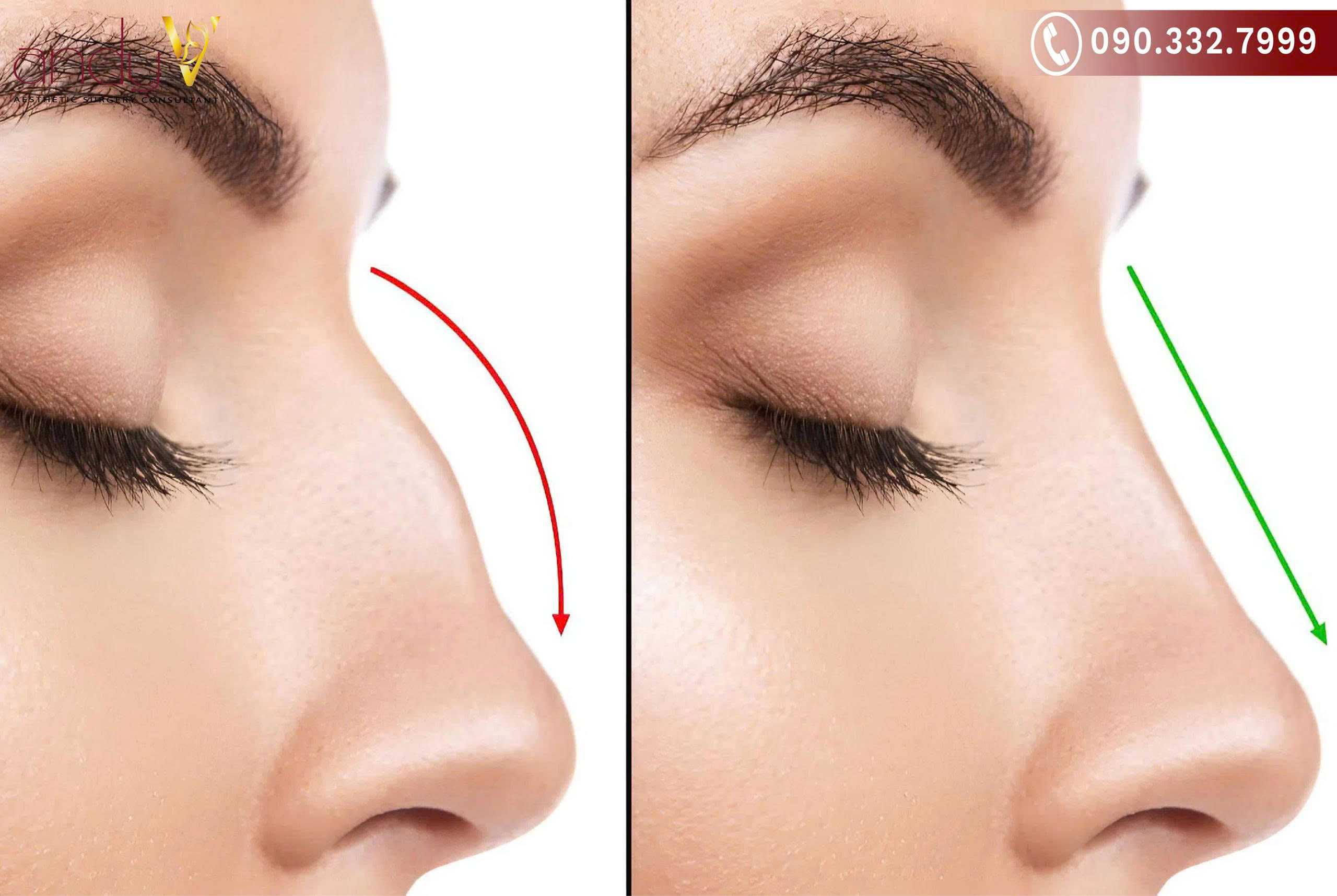 Dài, nhọn và có xu hướng cong, quặp xuống dưới, gần sát với môi trên, trông giống mỏ chim diều hâu