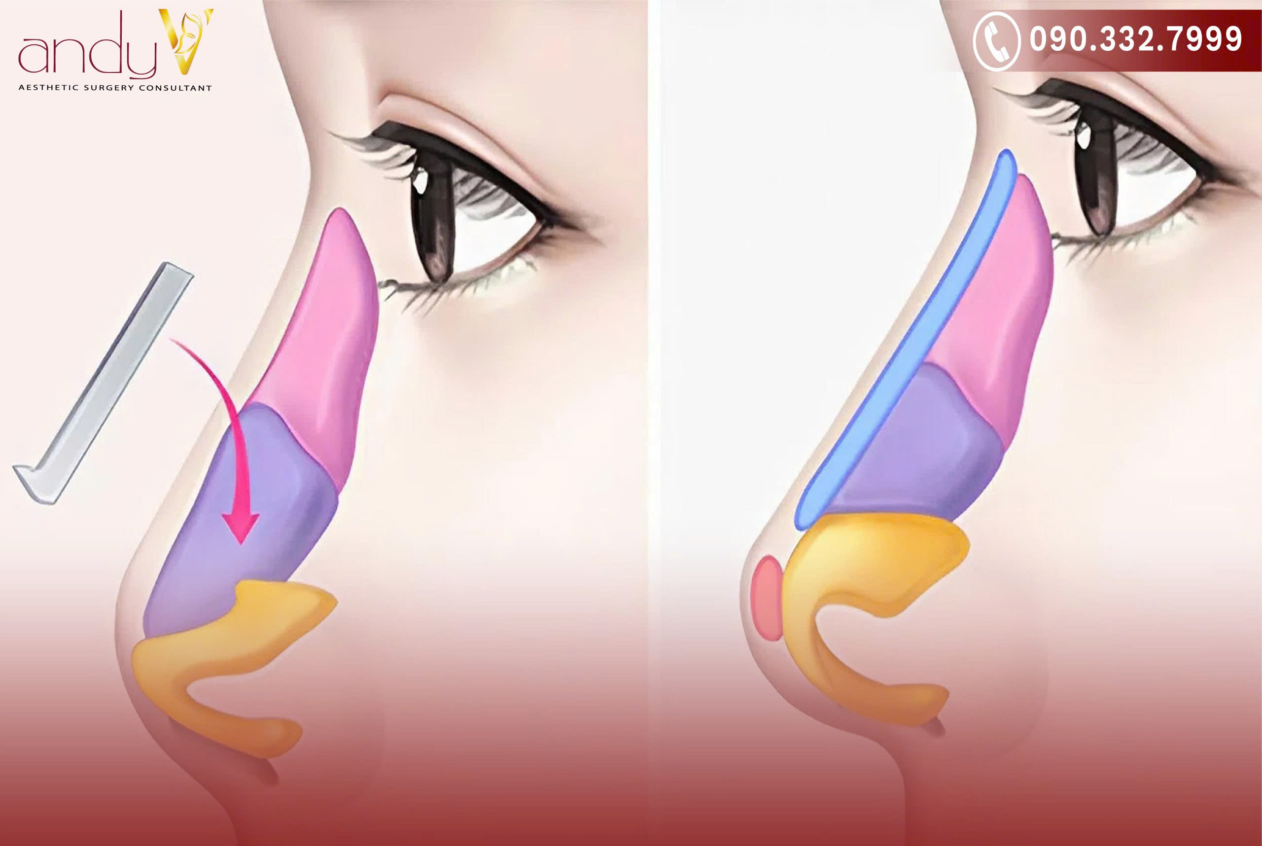 Khắc phục dáng mũi hổ thường được thực hiện thông qua các phương pháp thẩm mỹ