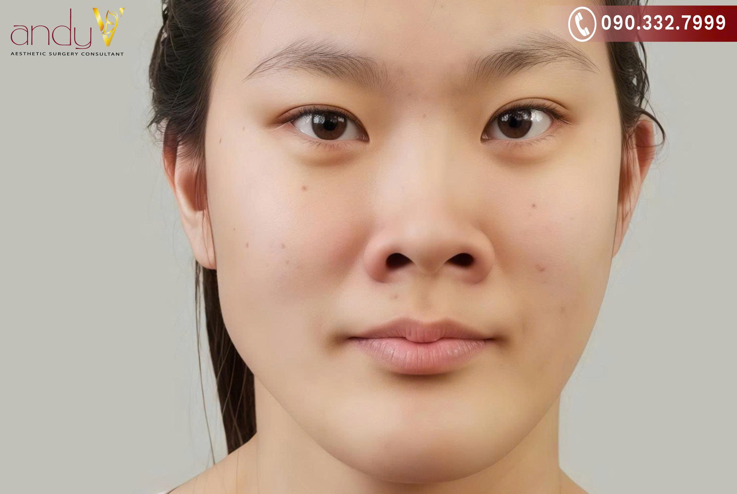 Khi nhìn thẳng, phần cánh mũi hai bên thường to bè, không thon gọn