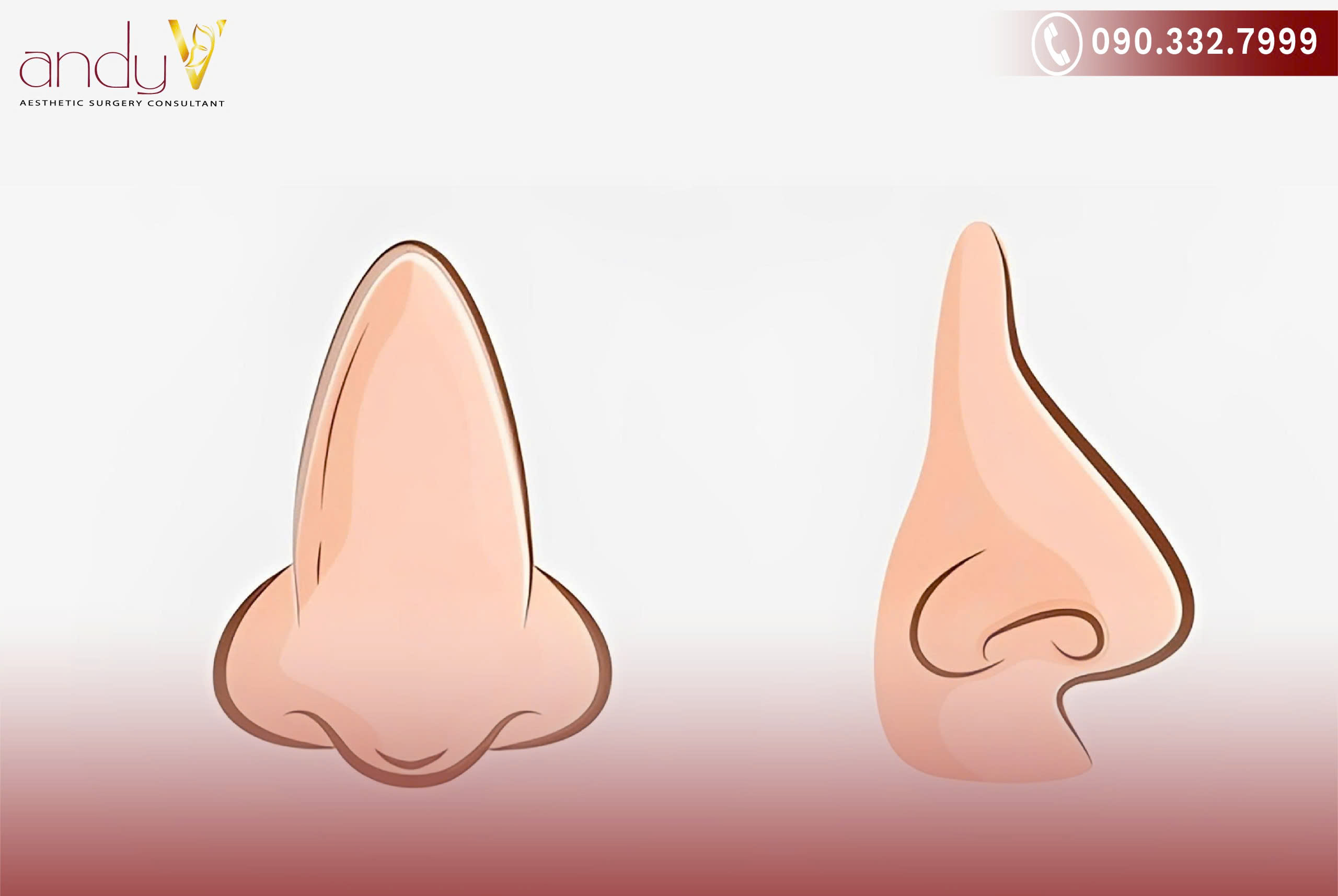 Sống mũi của người có mũi túi mật thường thẳng và có độ cao vừa phải