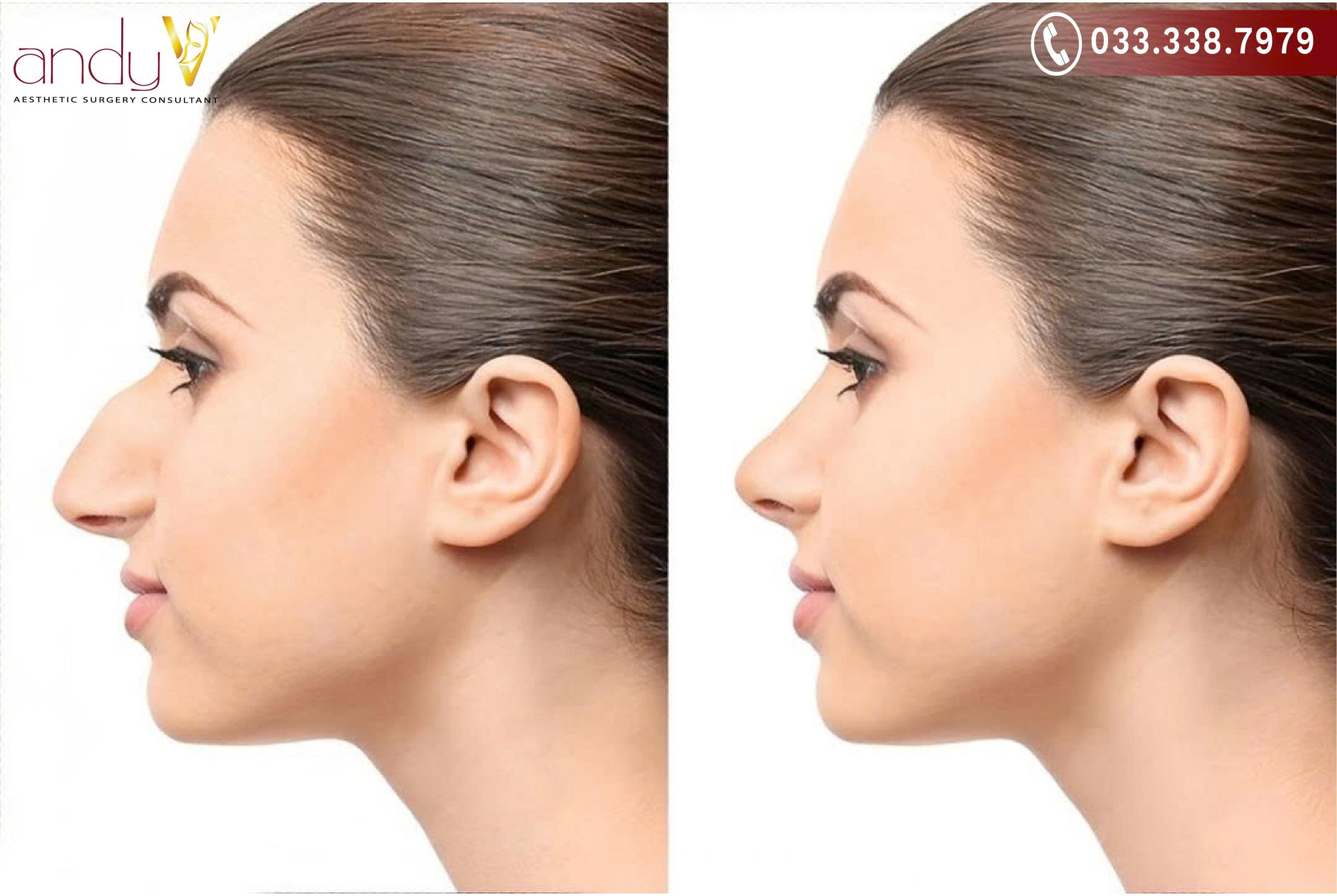 Nâng mũi cấu trúc là phương pháp toàn diện cho mũi gồ, quặp, kết hợp gọt xương, nâng sống và chỉnh đầu mũi