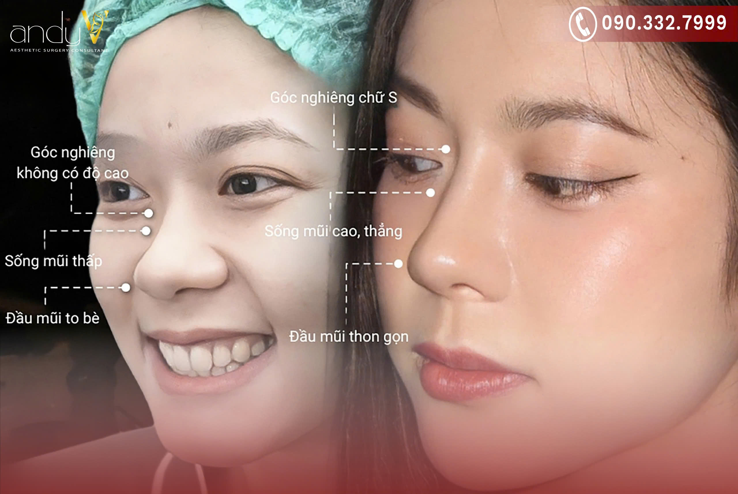 Nếu bạn muốn có một dáng mũi dọc dừa bền vững và thay đổi rõ rệt, phẫu thuật thẩm mỹ là lựa chọn tối ưu