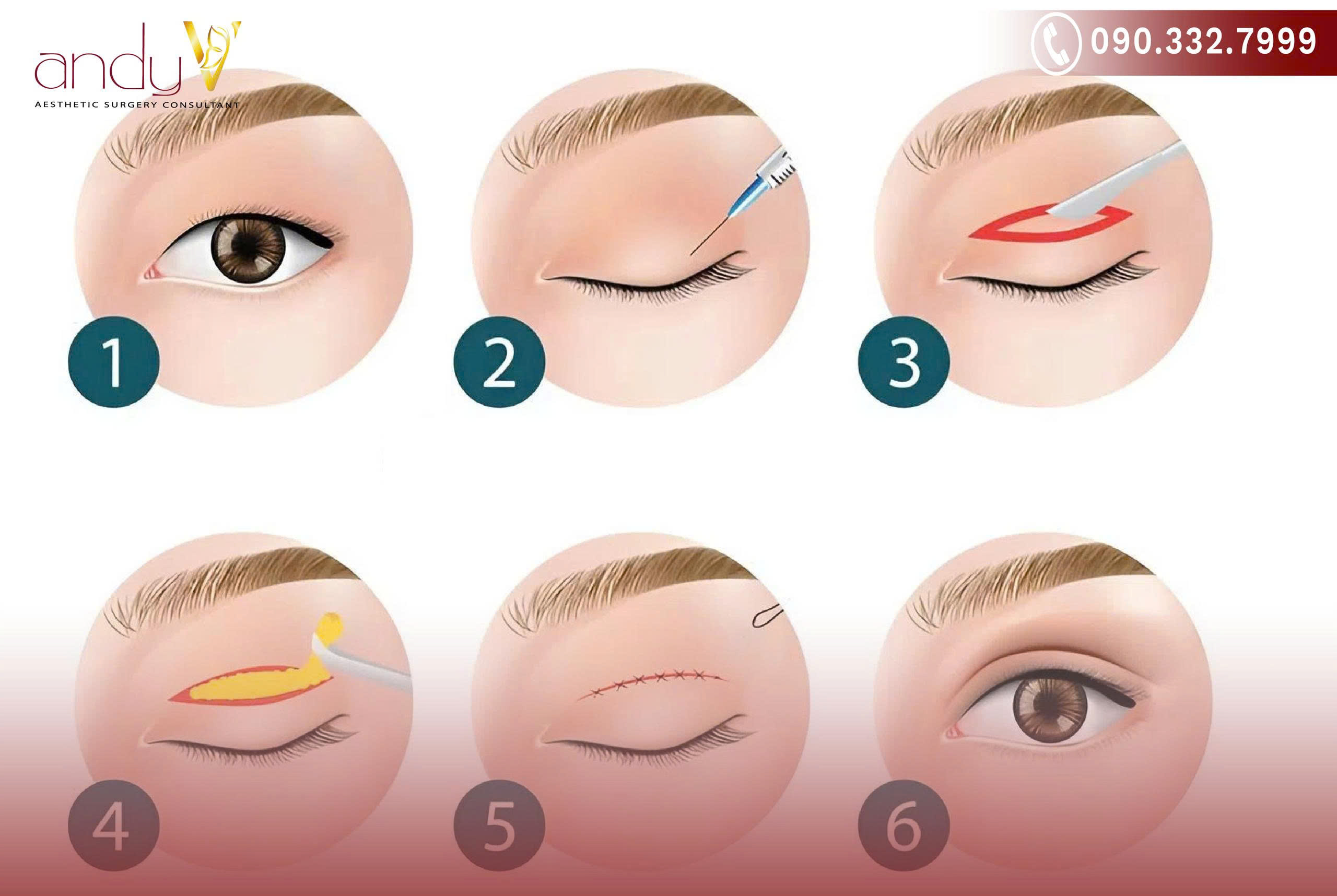Quy trình phẫu thuật cắt mí mắt là một tiểu phẫu thẩm mỹ tương đối phổ biến