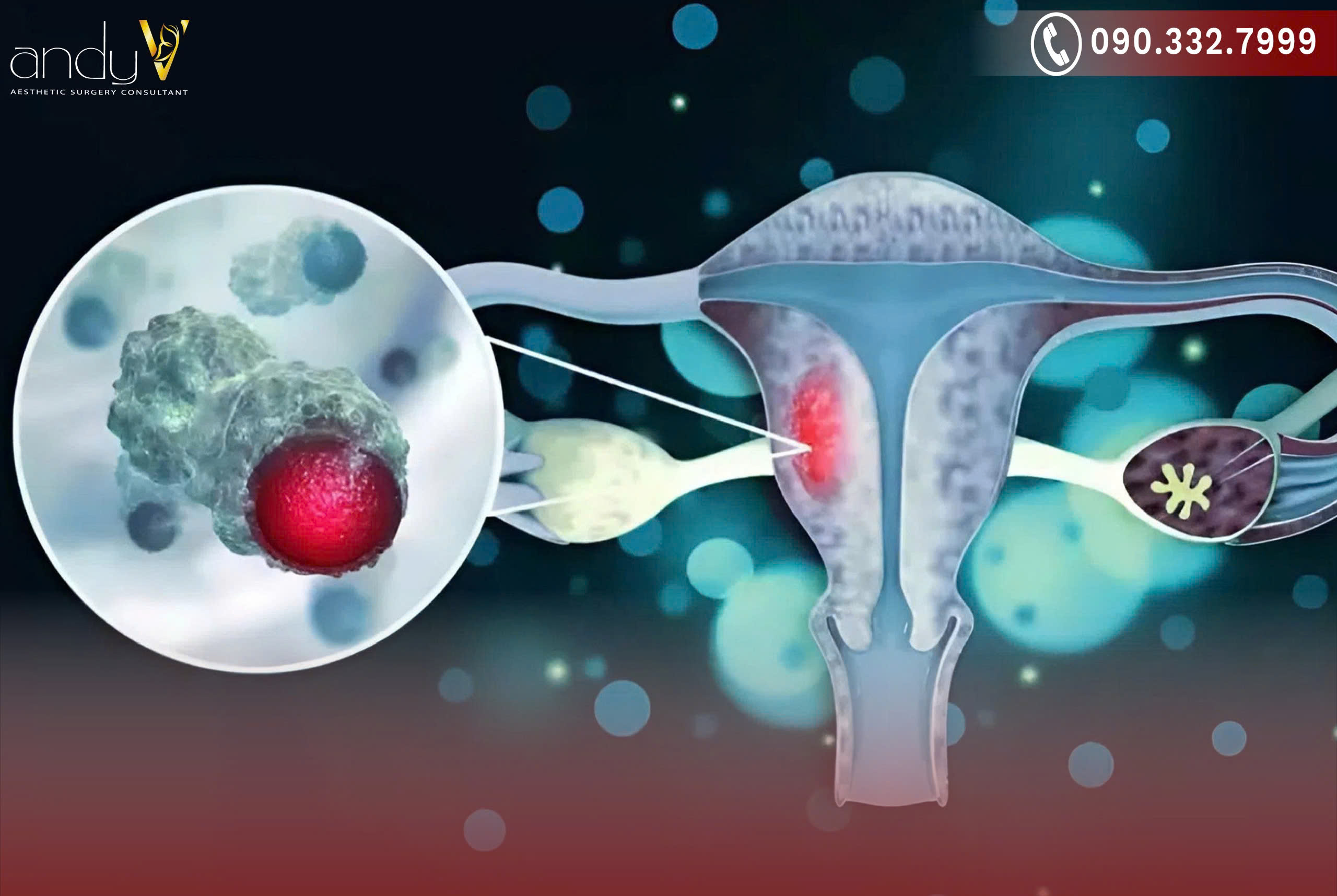 Vi khuẩn từ các vùng này có thể lan truyền lên tử cung và gây viêm nhiễm