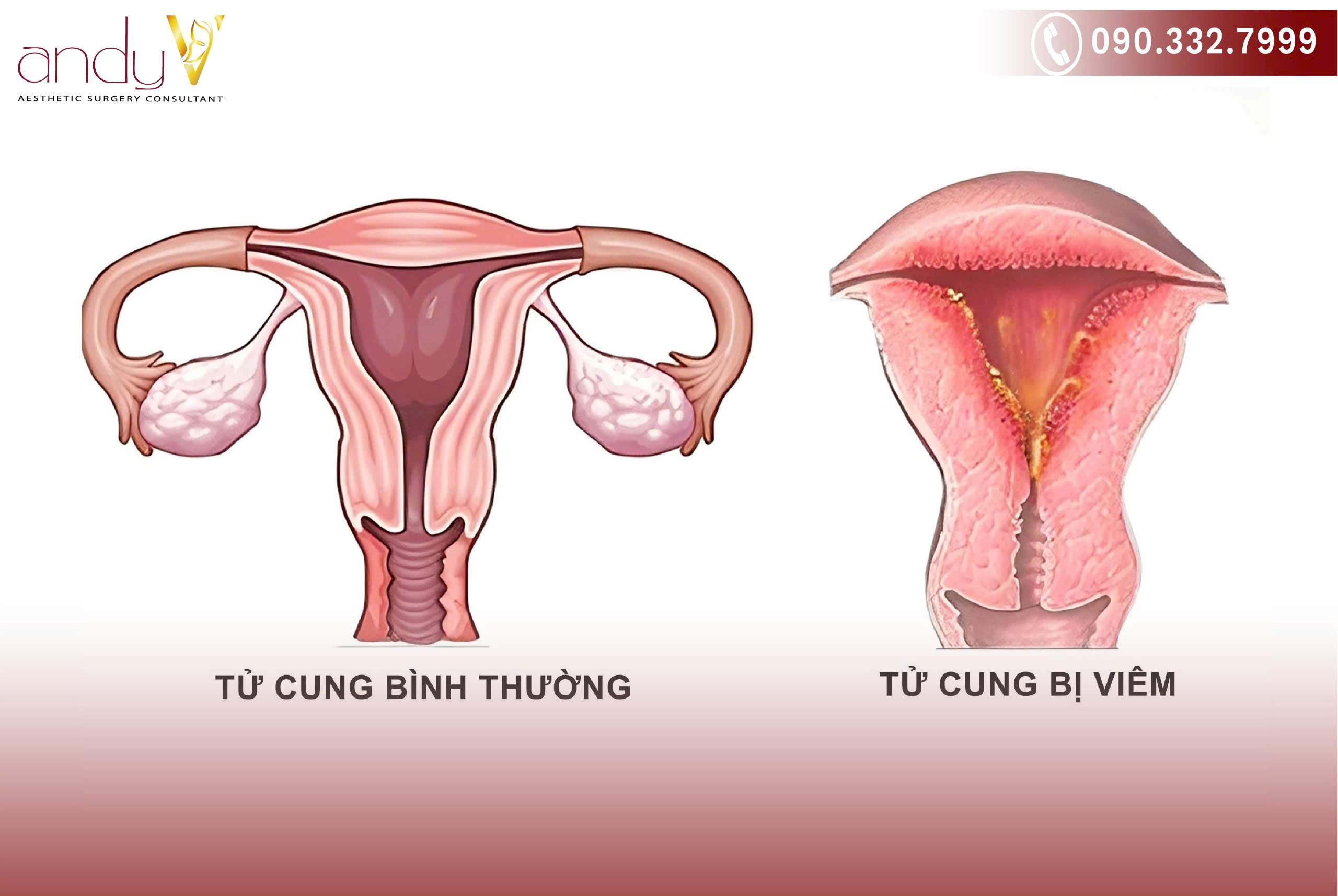 Nhiễm trùng tử cung có nguy hiểm không?