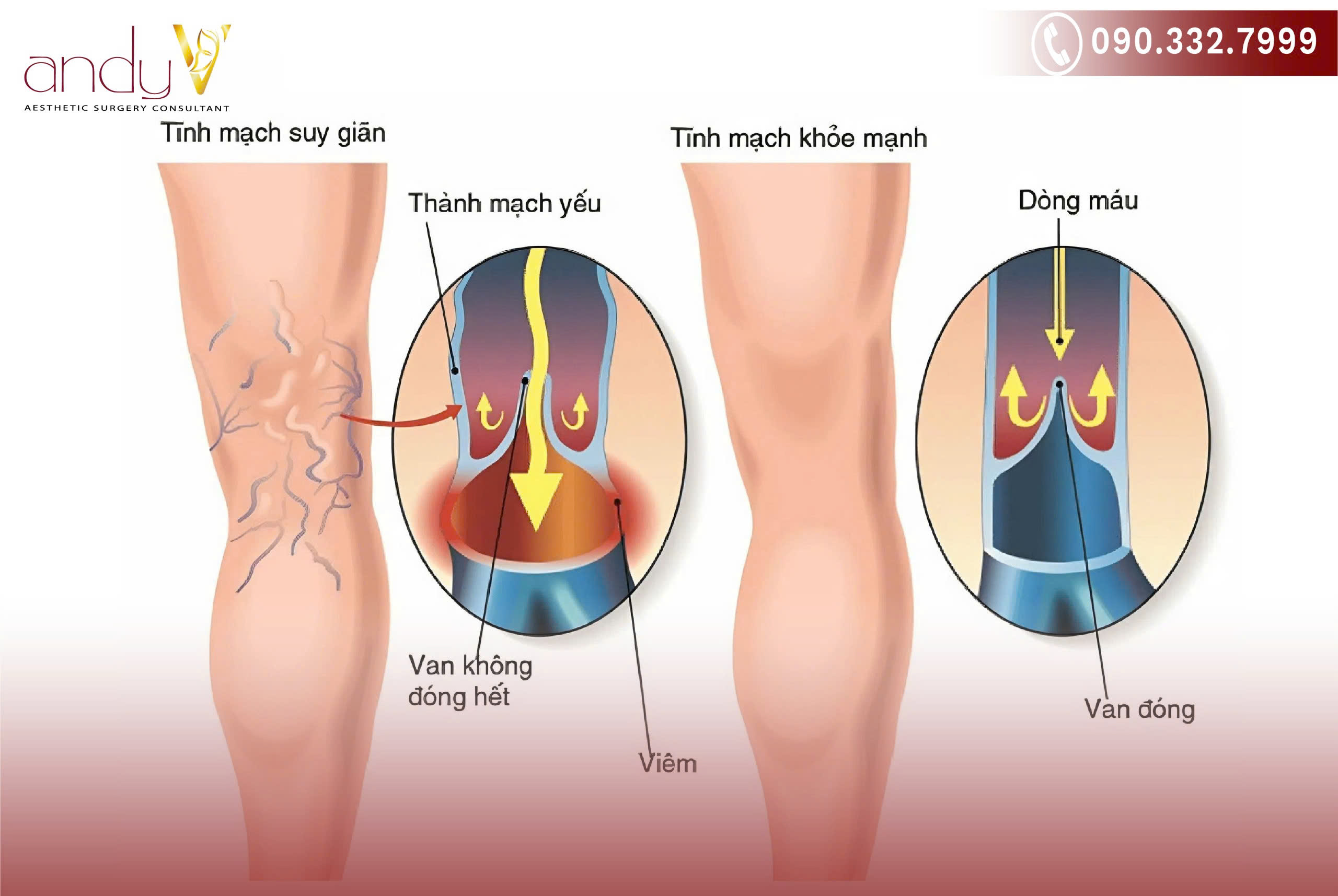 Hình ảnh minh họa viêm tắc tĩnh mạch chi dưới
