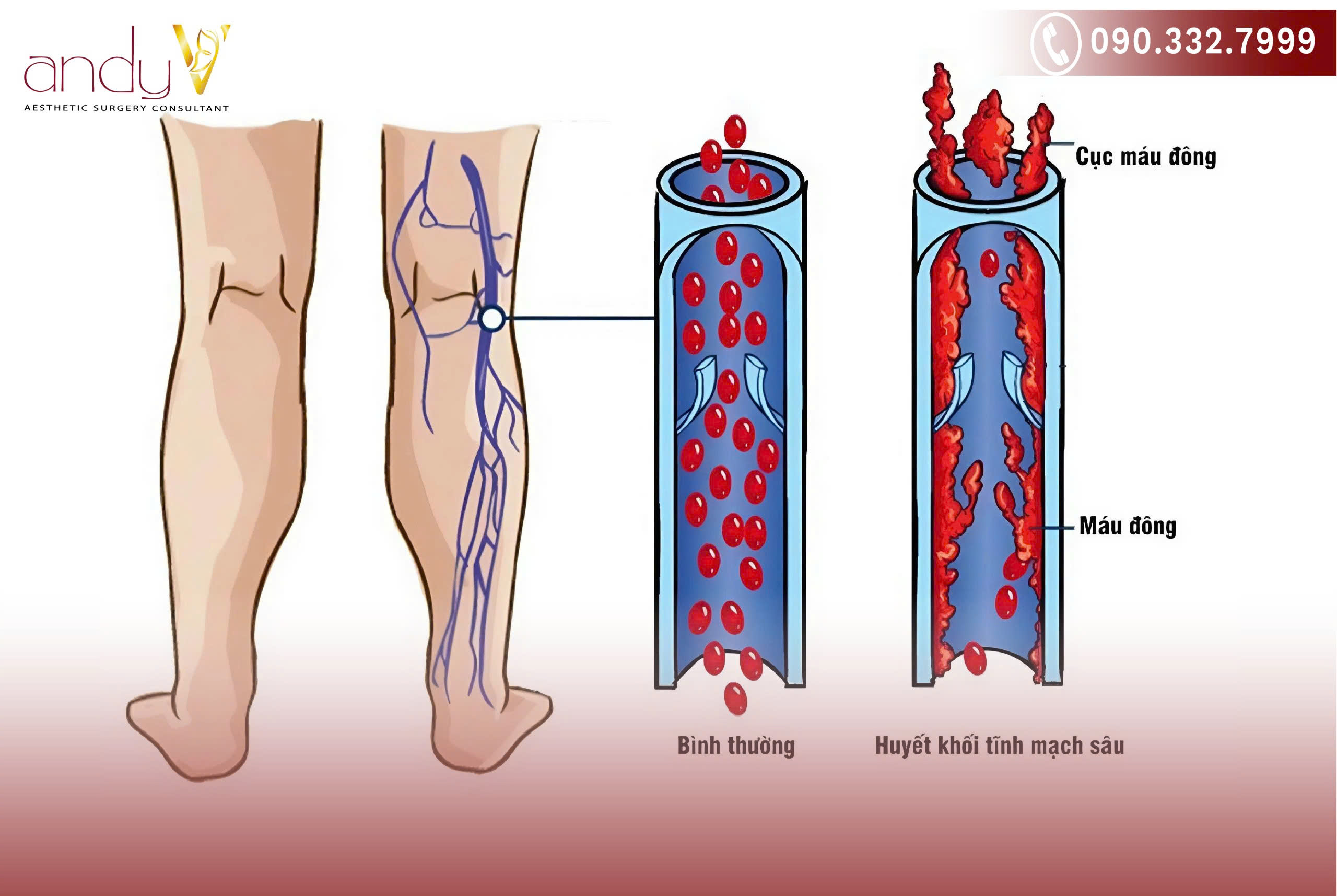 Bị tắc tĩnh mạch chân phải làm sao?