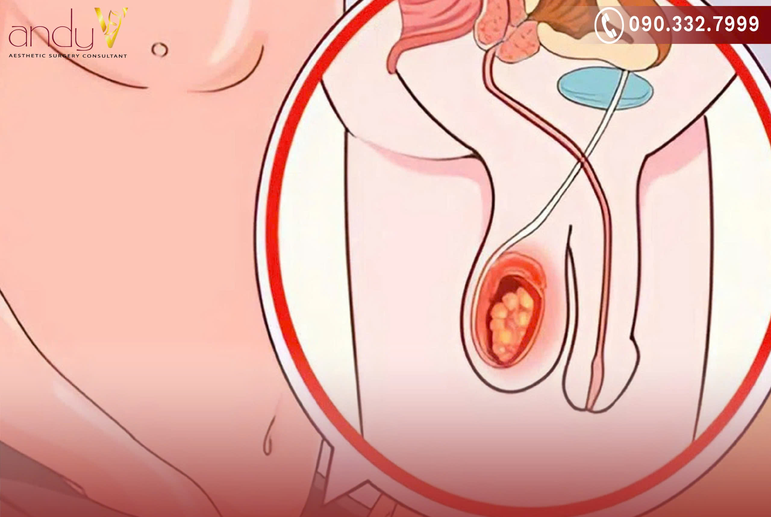 Nguyên nhân chính gây viêm tinh hoàn là nhiễm virus và nhiễm vi khuẩn