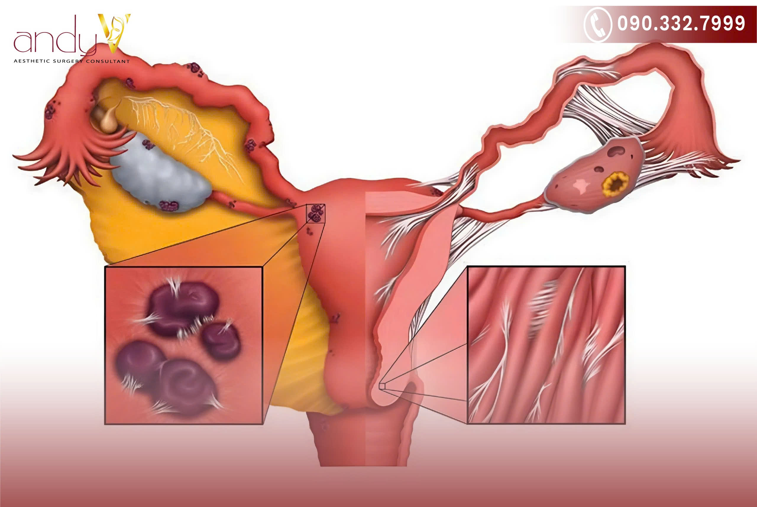 Mất cân bằng của các hormone sinh sản là Estrogen và Progesterone