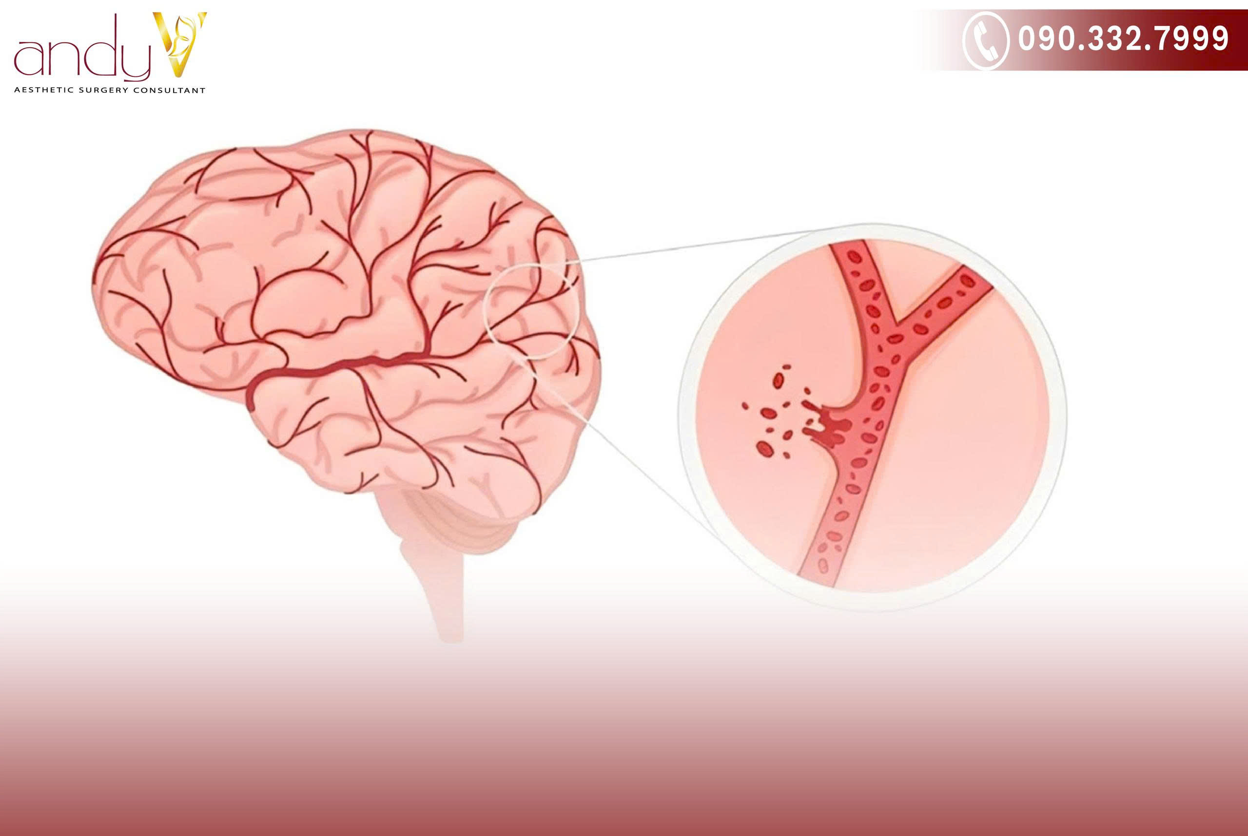 Huyết áp tăng cao gây áp lực lên mạch máu não có thể gây vỡ mạch máu