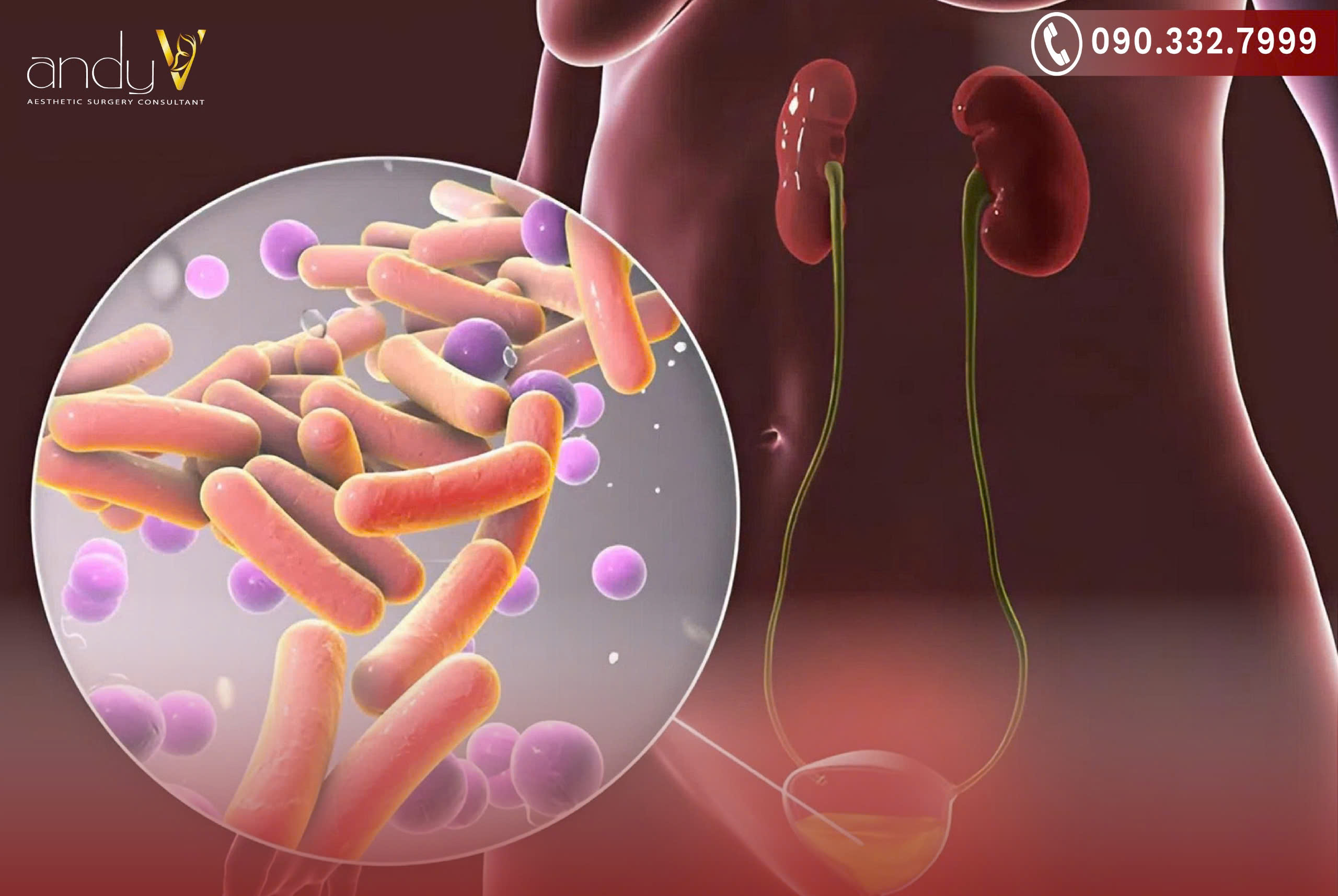 Nhiễm khuẩn E. coli tái phát do điều trị không dứt điểm