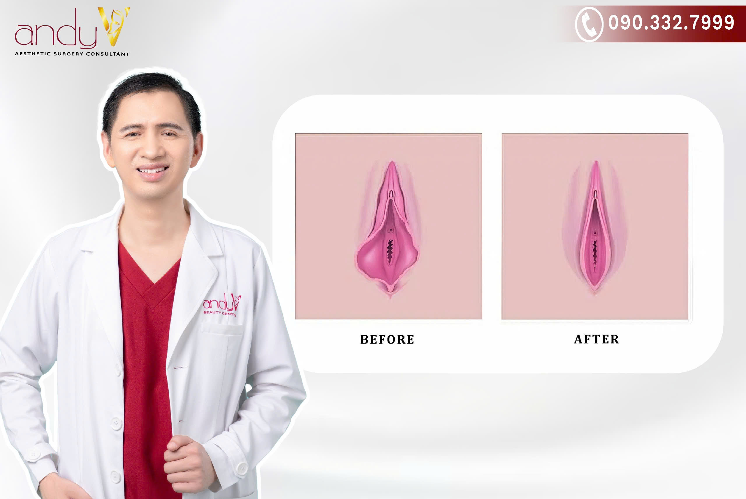 Quá trình lành vết thương cắt môi bé phì đại