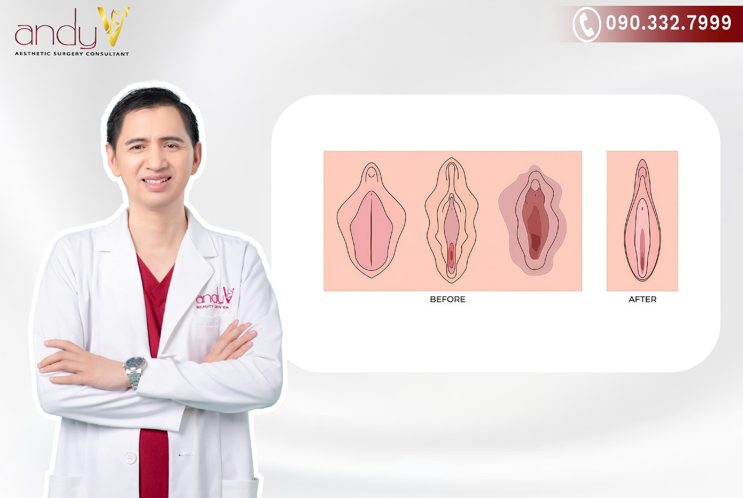 Kích thước môi bé quá lớn gây khó khăn trong việc giữ vệ sinh