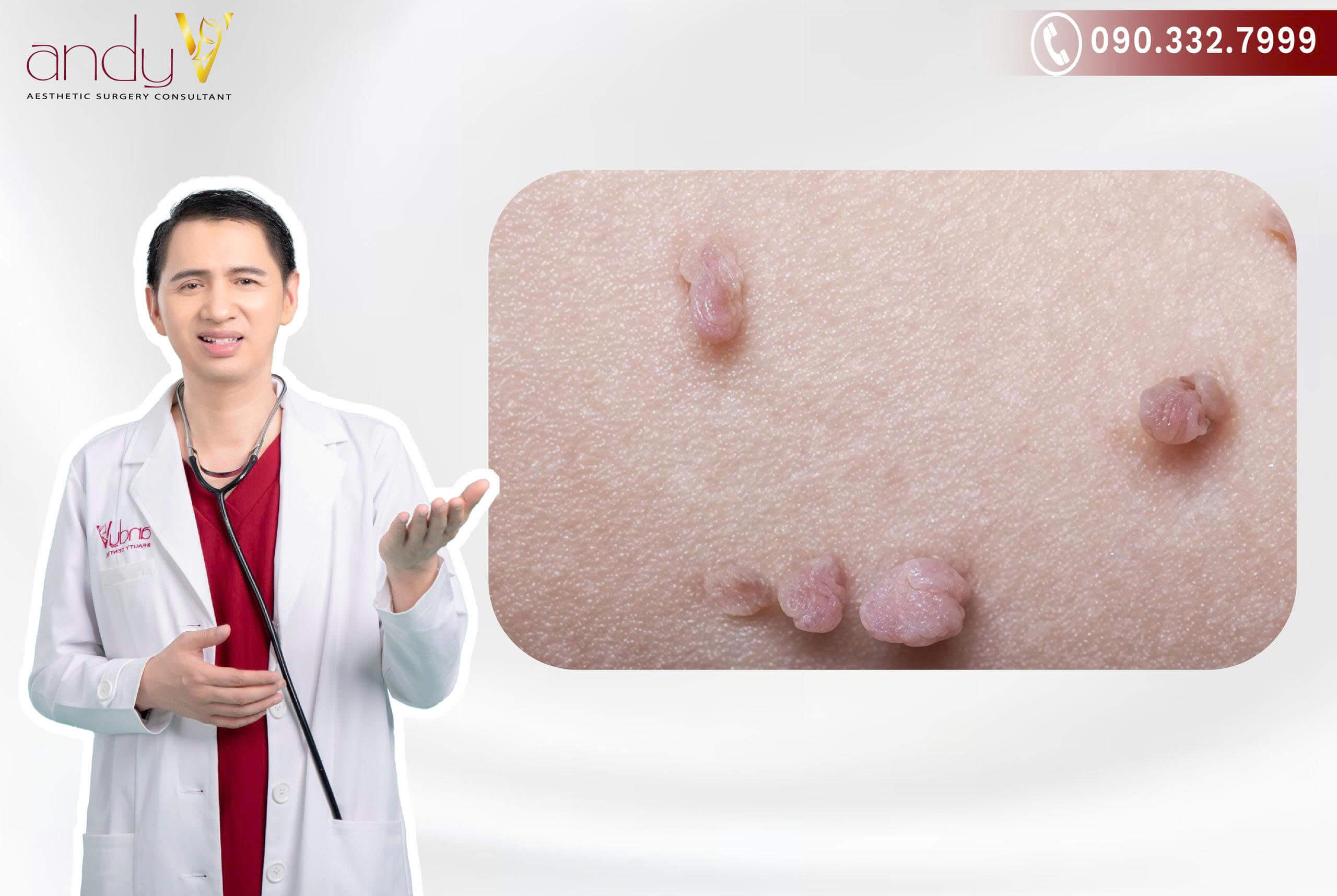 Nhận biết bệnh do Virus gây u nhú ở người (HPV) gây ra trên cơ thể